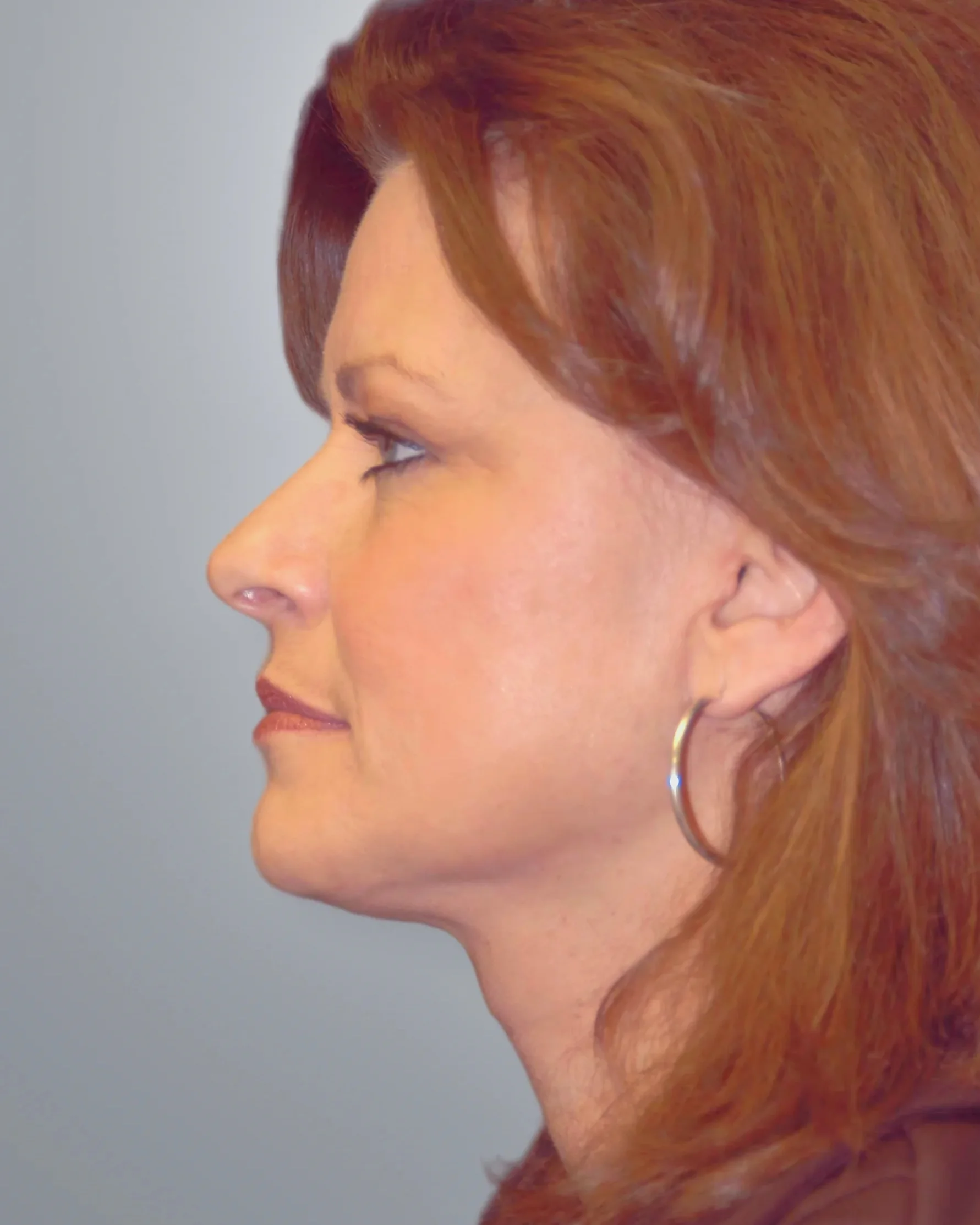 Facelift + Neck Lift + Midface Lift after, Edition Plastic Surgery patient