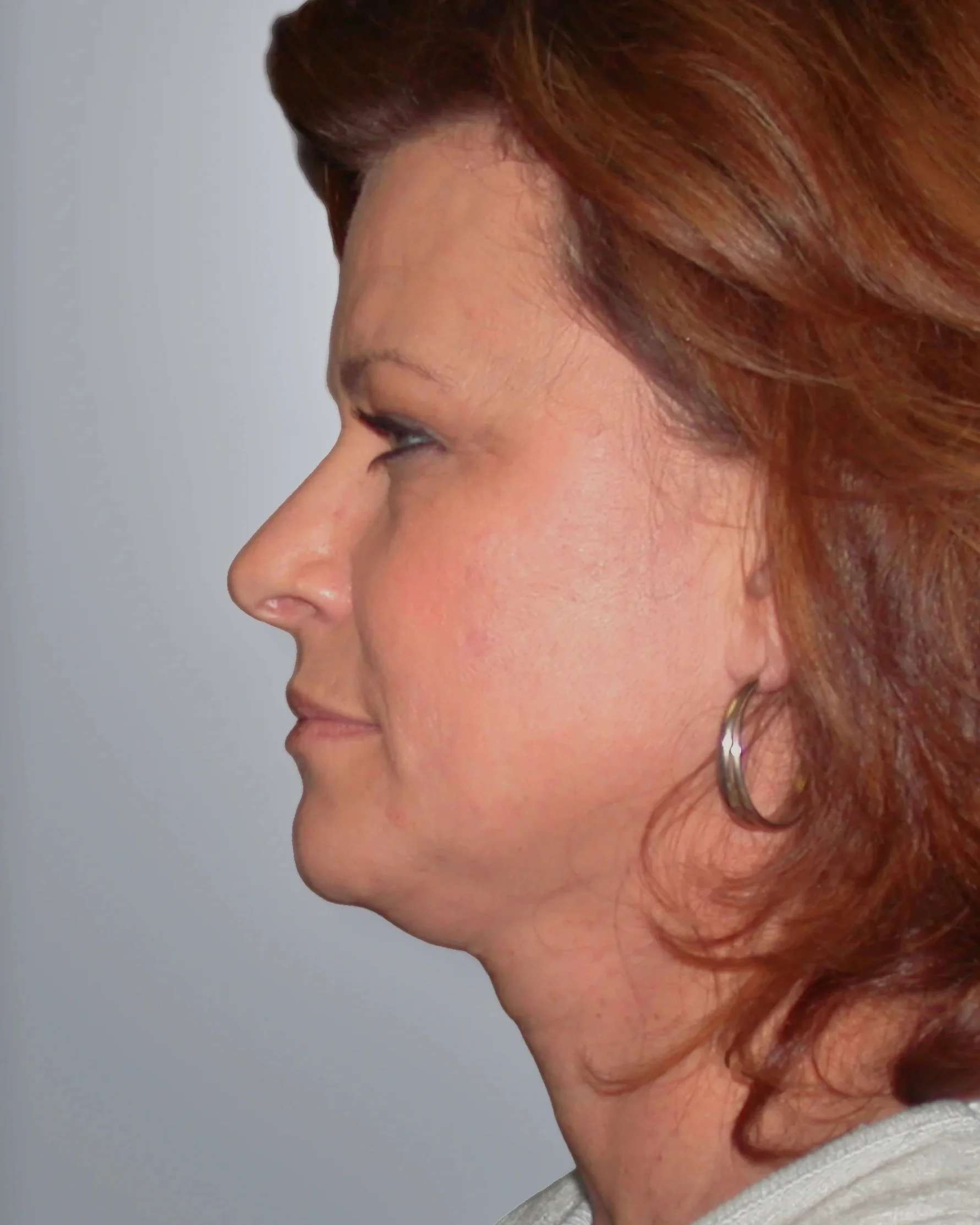 Facelift + Neck Lift + Midface Lift before, Edition Plastic Surgery patient