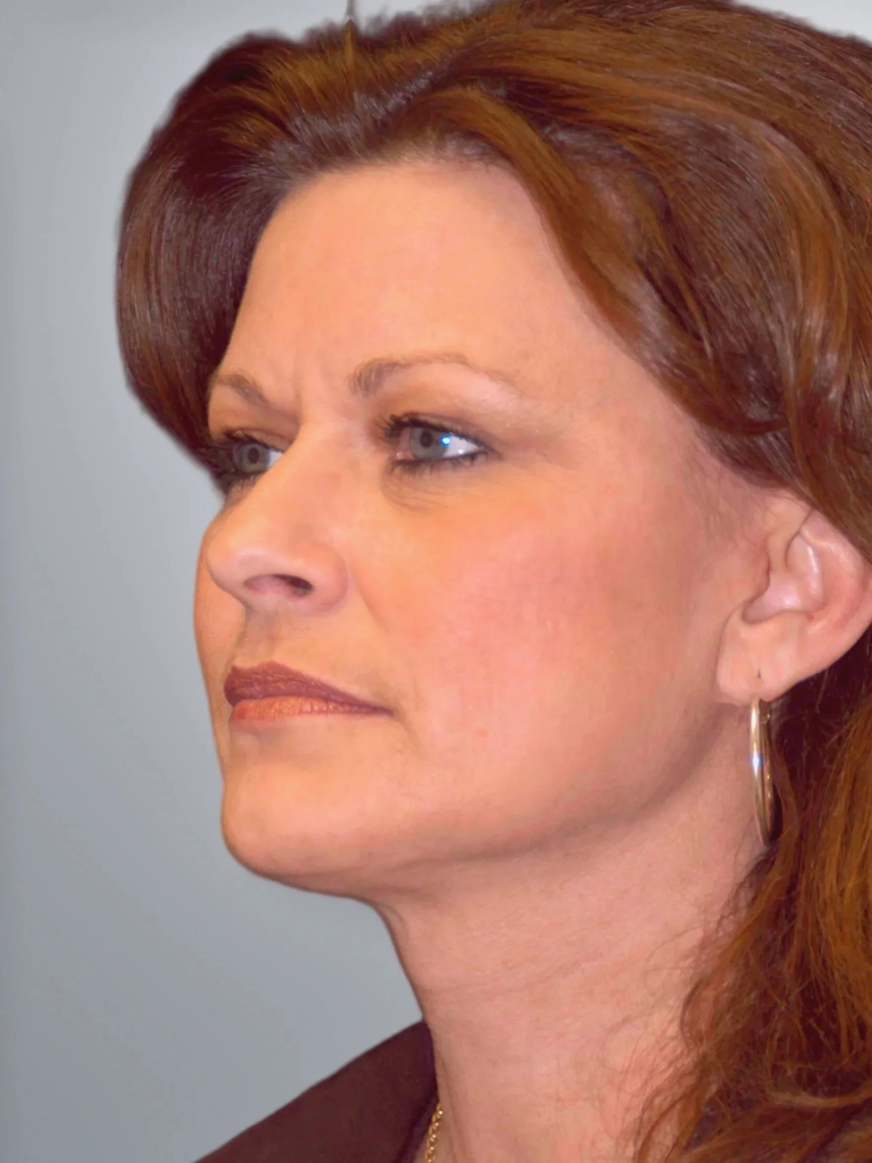 Facelift + Neck Lift + Midface Lift after, Edition Plastic Surgery patient