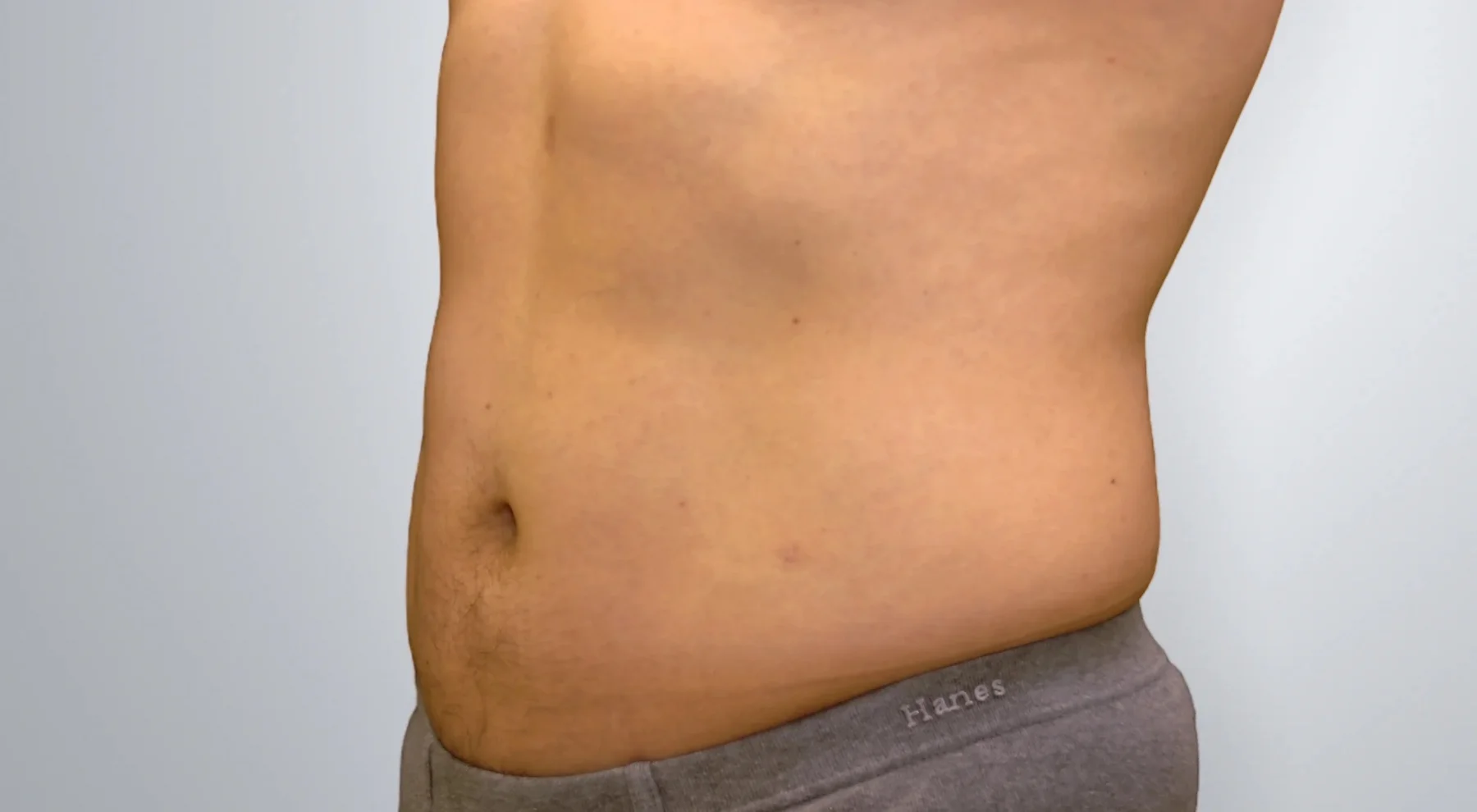 Liposuction after, Edition Plastic Surgery patient