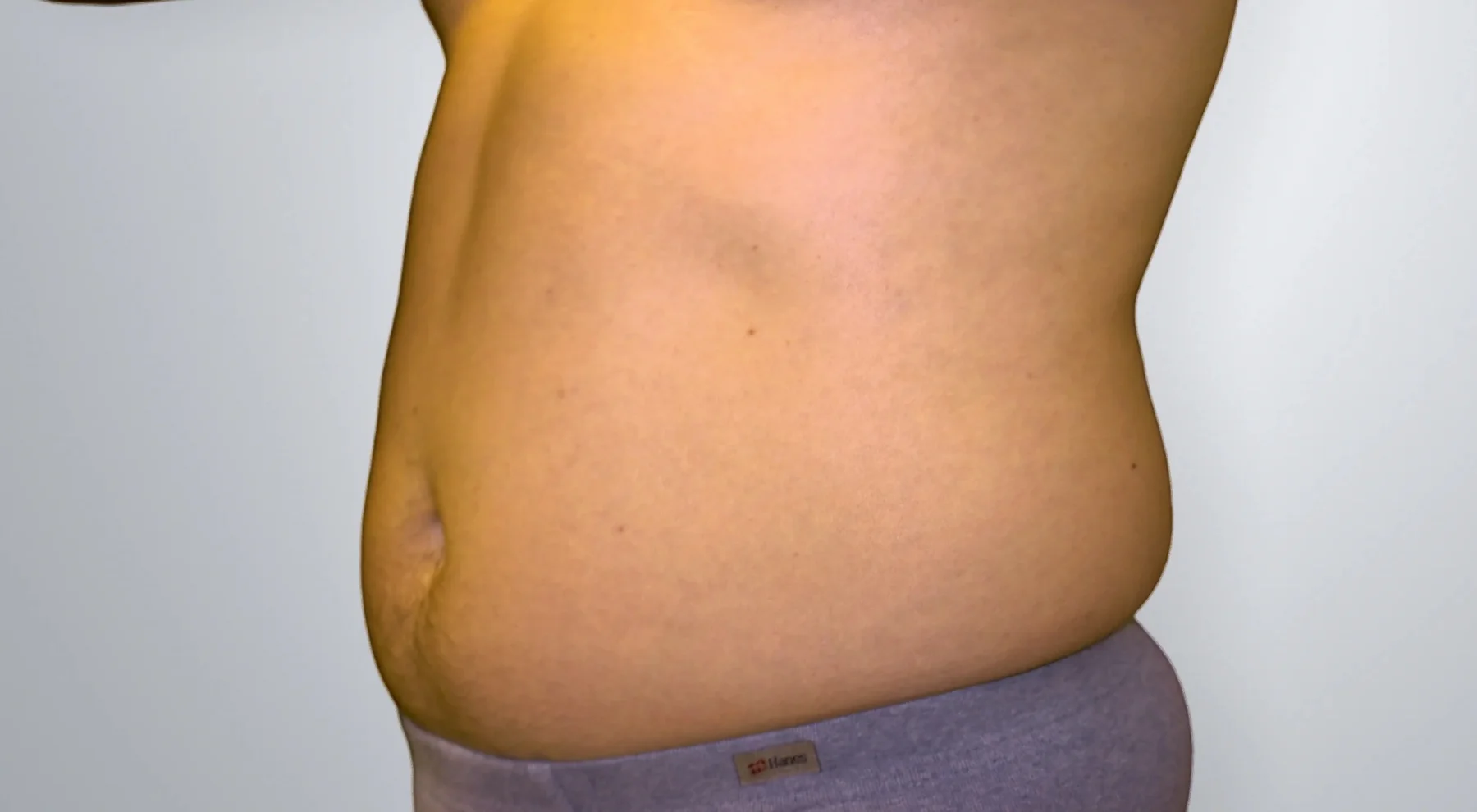 Liposuction before, Edition Plastic Surgery patient