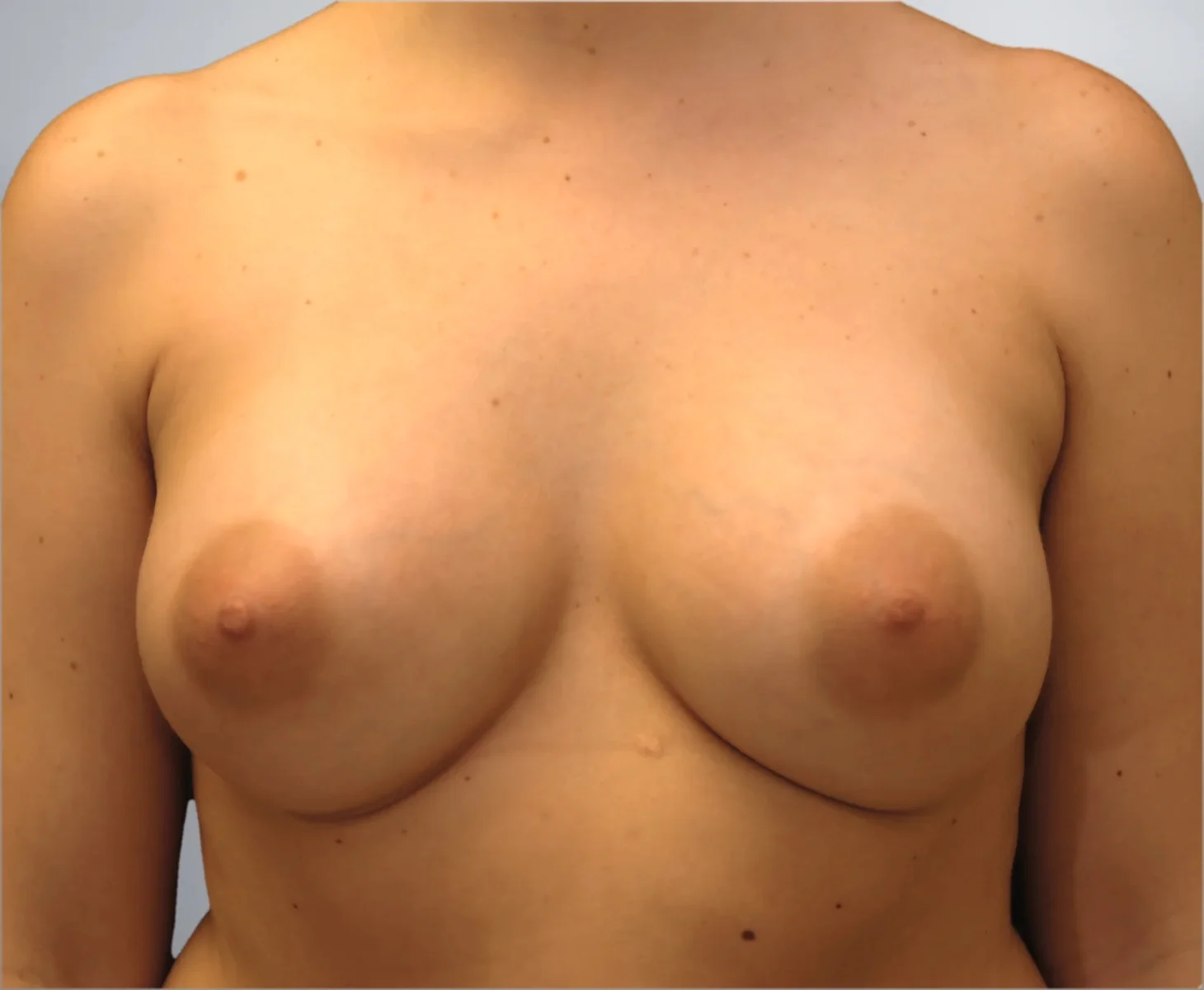 Breast Augmentation after, Edition Plastic Surgery patient