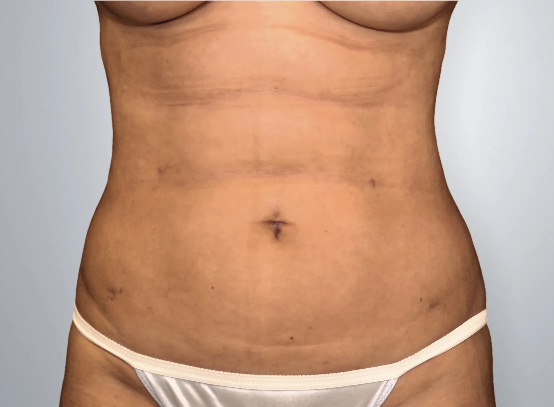 Liposuction after, Edition Plastic Surgery patient