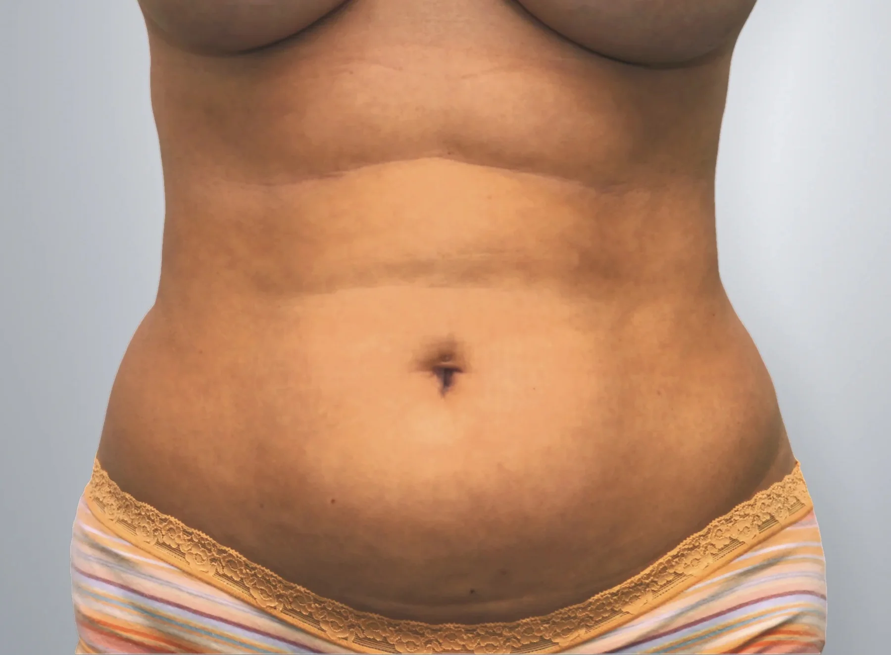 Liposuction before, Edition Plastic Surgery patient
