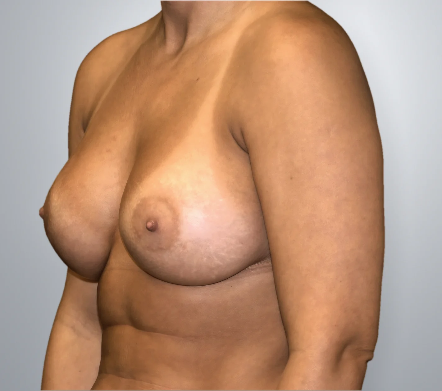 Breast Augmentation after, Edition Plastic Surgery patient