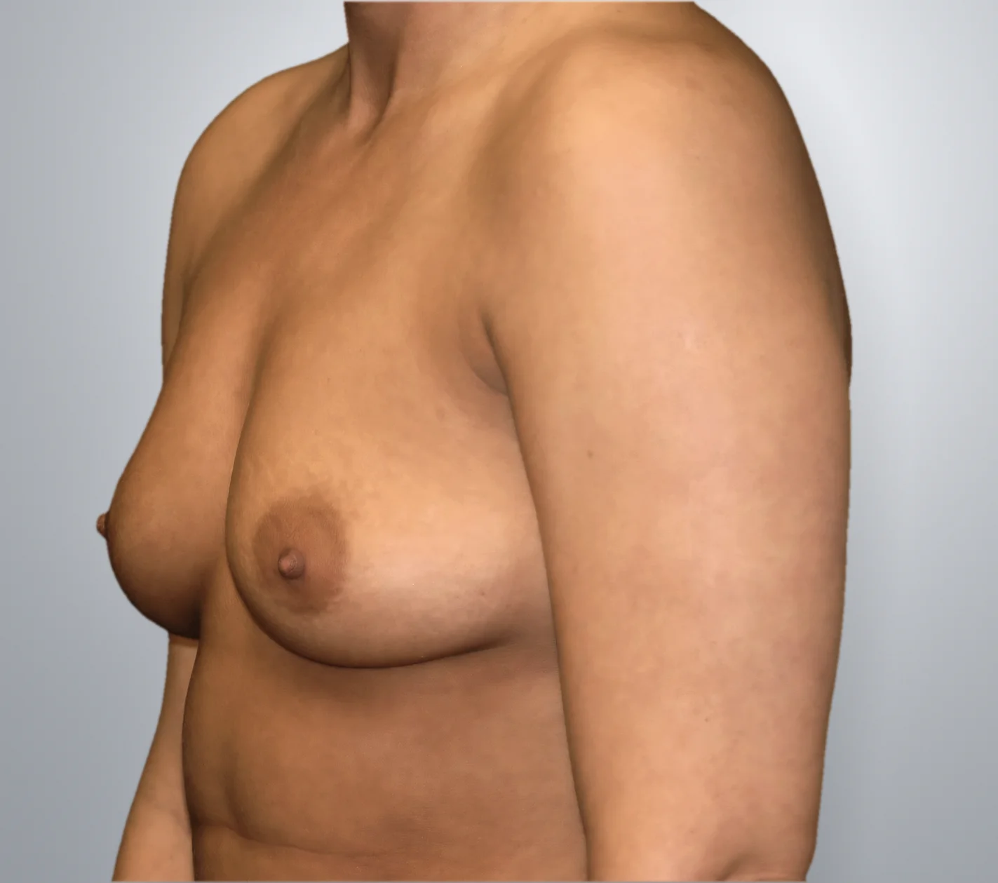 Breast Augmentation before, Edition Plastic Surgery patient