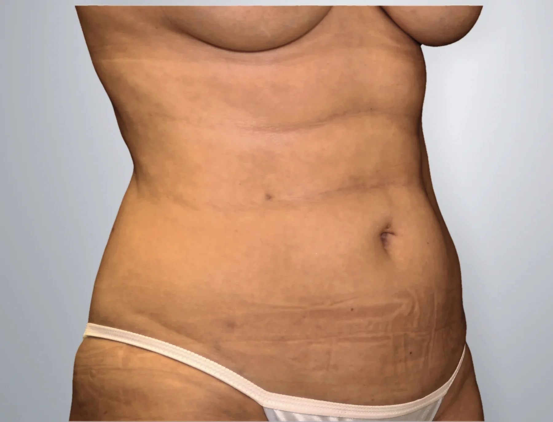 Liposuction after, Edition Plastic Surgery patient