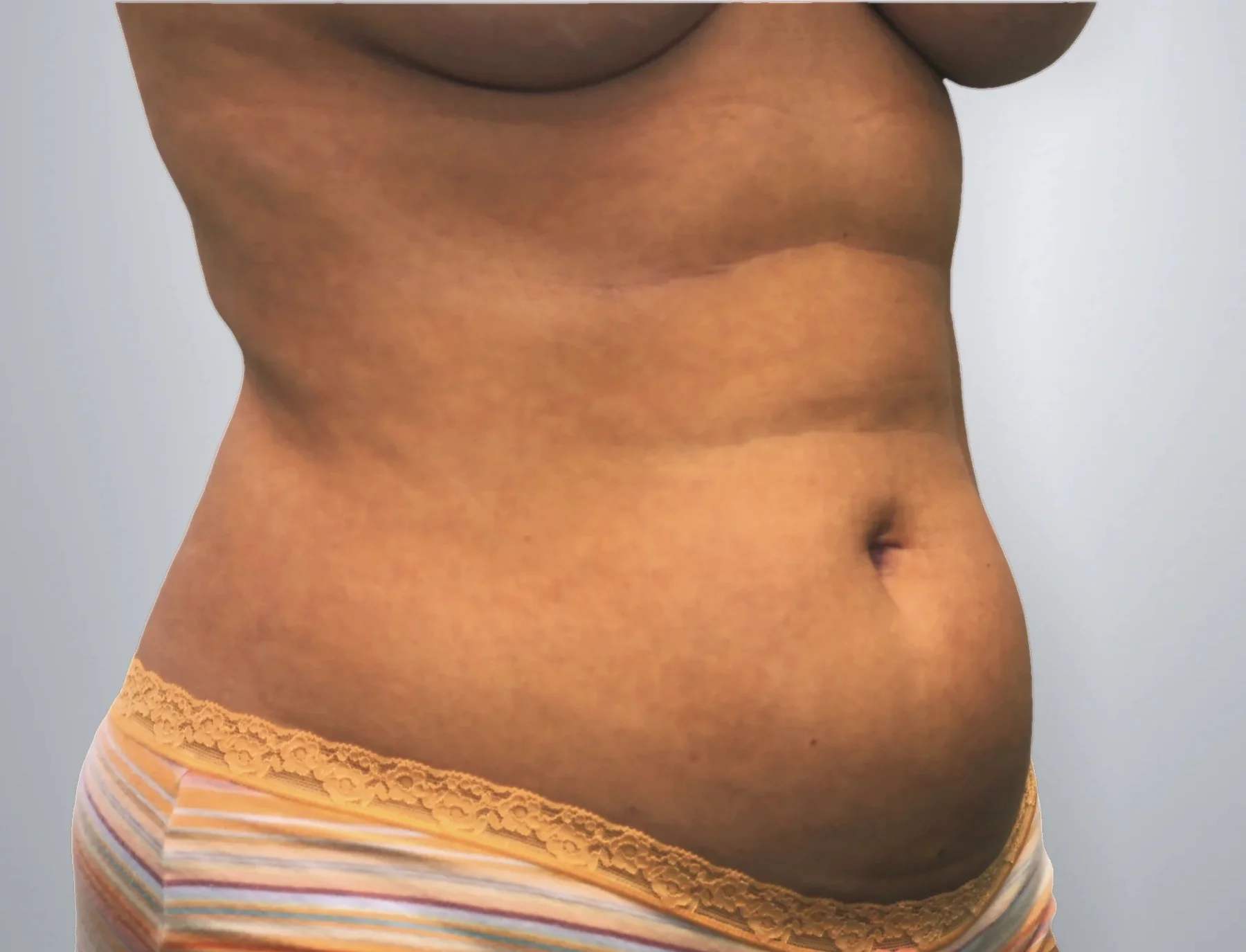 Liposuction before, Edition Plastic Surgery patient