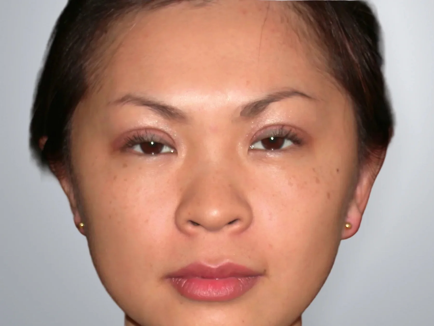 Otoplasty after, Edition Plastic Surgery patient