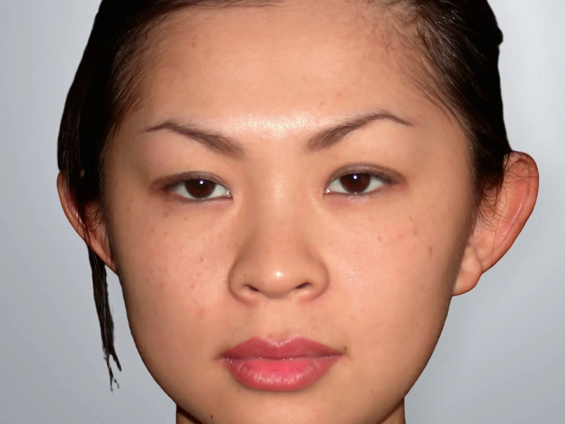 Otoplasty before, Edition Plastic Surgery patient