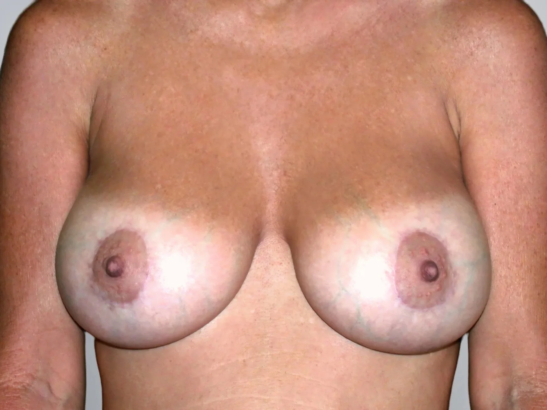 Breast Augmentation + Breast Lift after, Edition Plastic Surgery patient