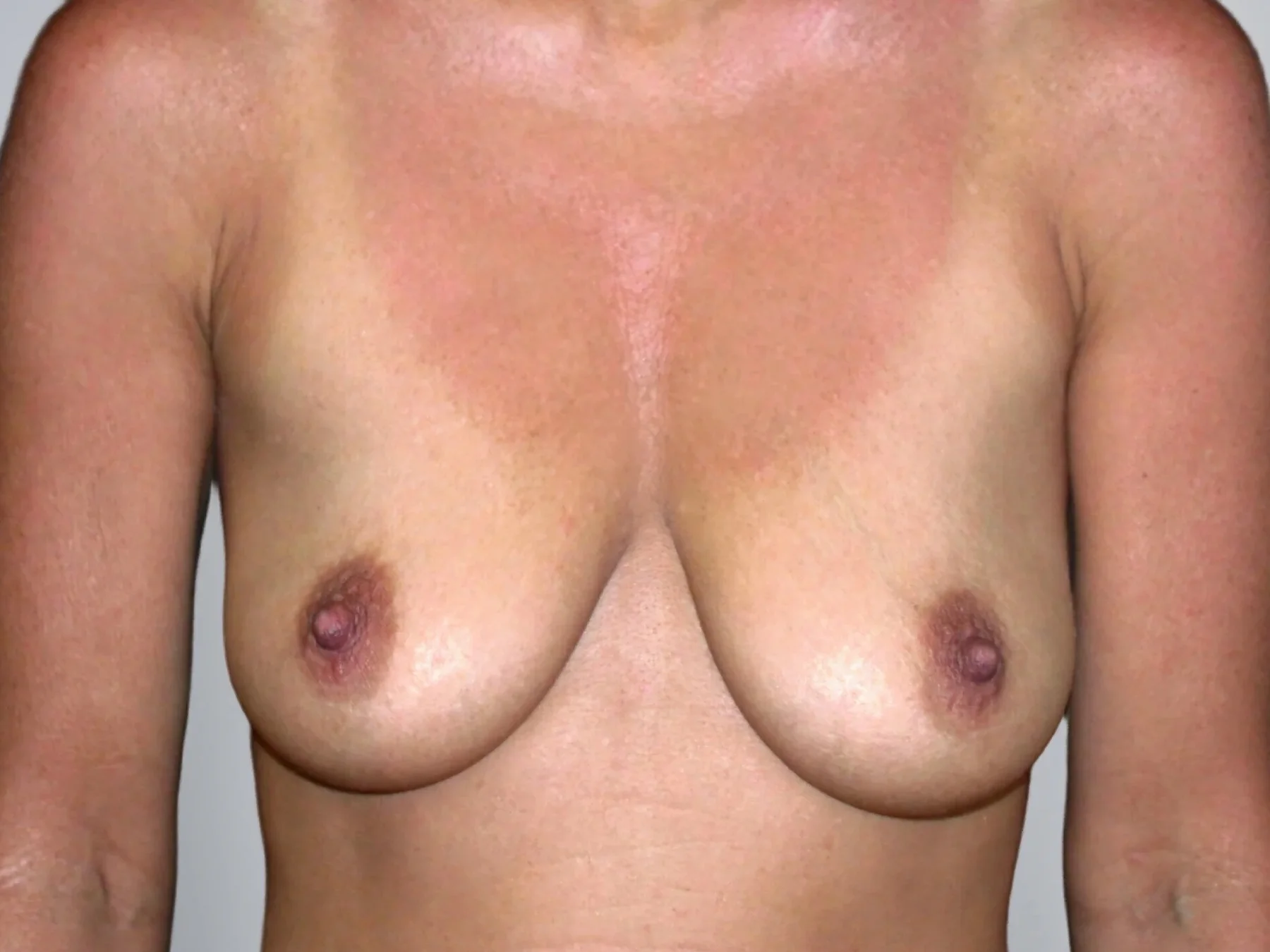 Breast Augmentation + Breast Lift before, Edition Plastic Surgery patient