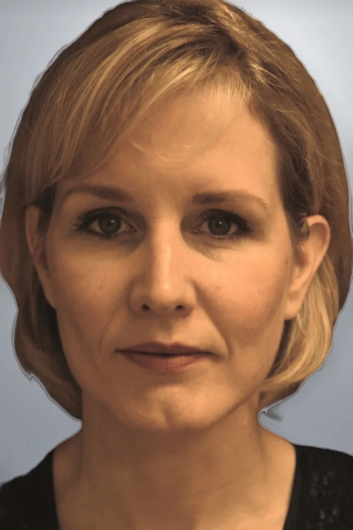 Facelift + Midface Lift + Neck Lift + Brow Lift after, Edition Plastic Surgery patient