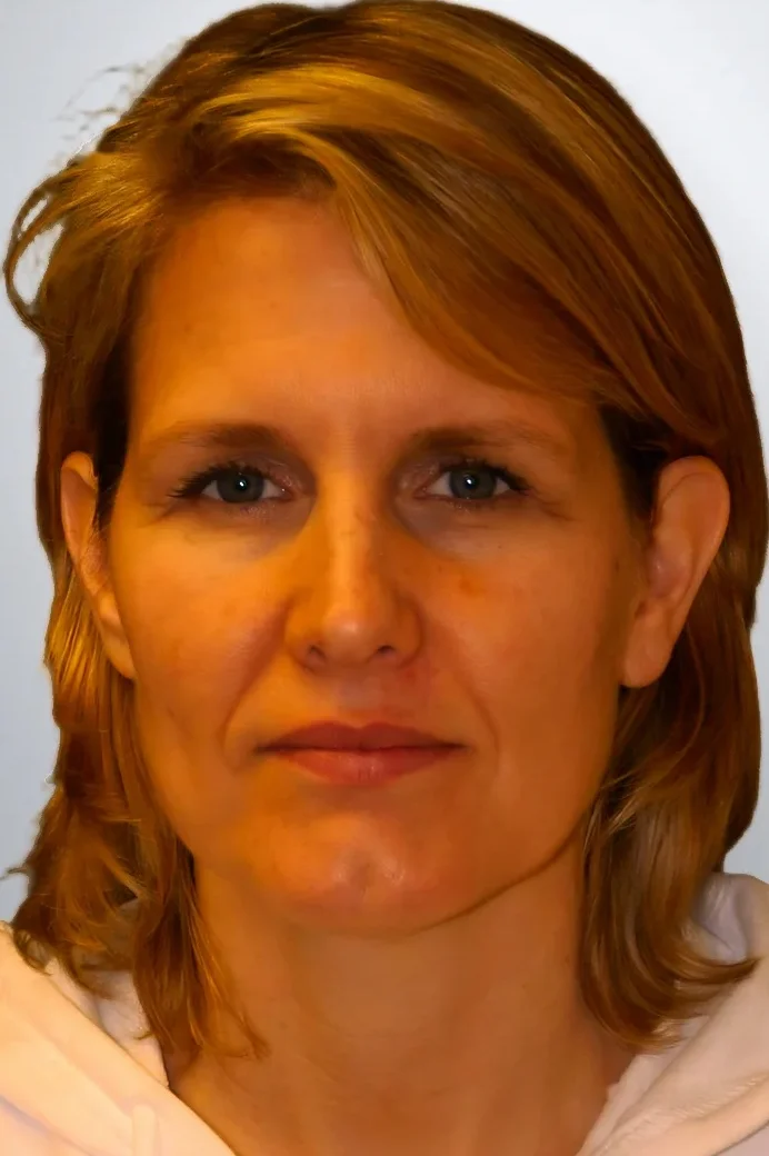 Facelift + Midface Lift + Neck Lift + Brow Lift before, Edition Plastic Surgery patient