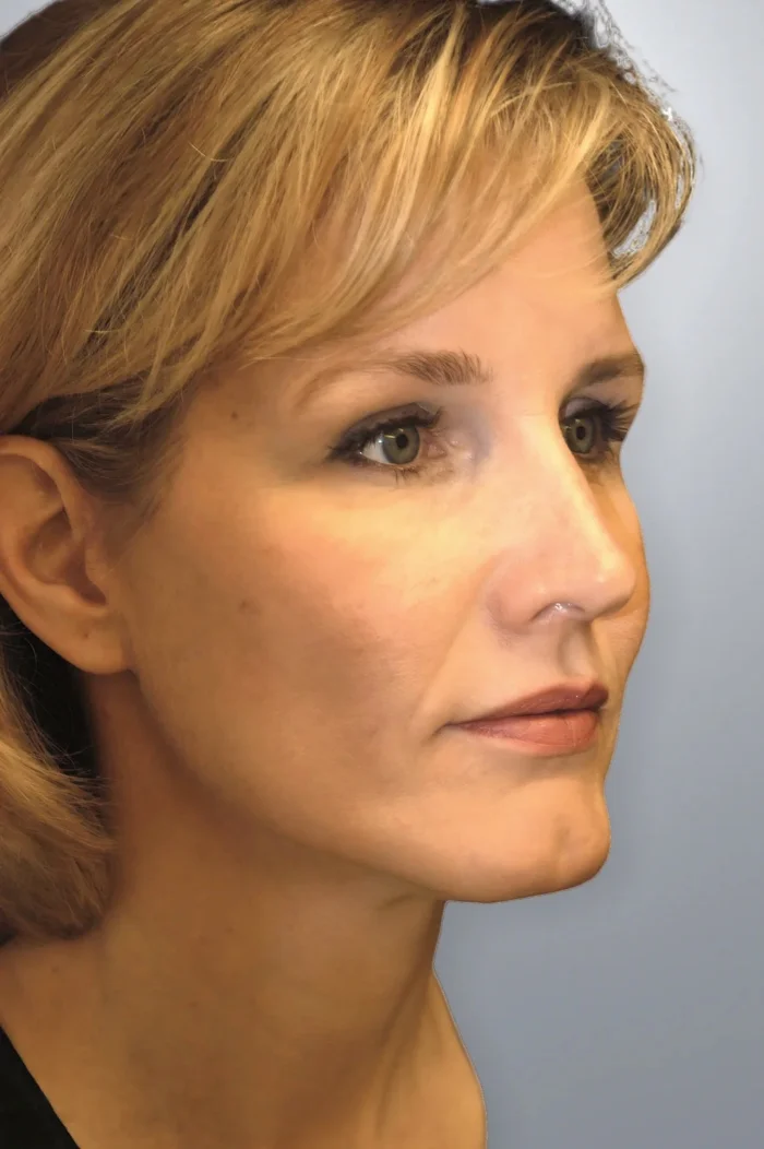 Facelift + Midface Lift + Neck Lift + Brow Lift after, Edition Plastic Surgery patient