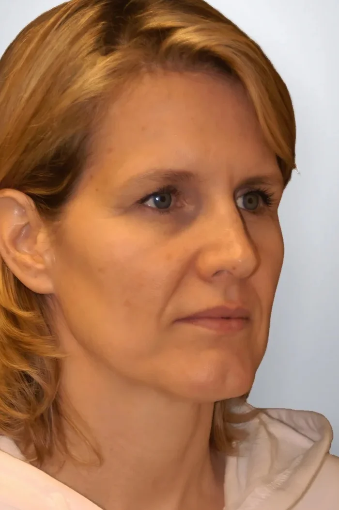 Facelift + Midface Lift + Neck Lift + Brow Lift before, Edition Plastic Surgery patient