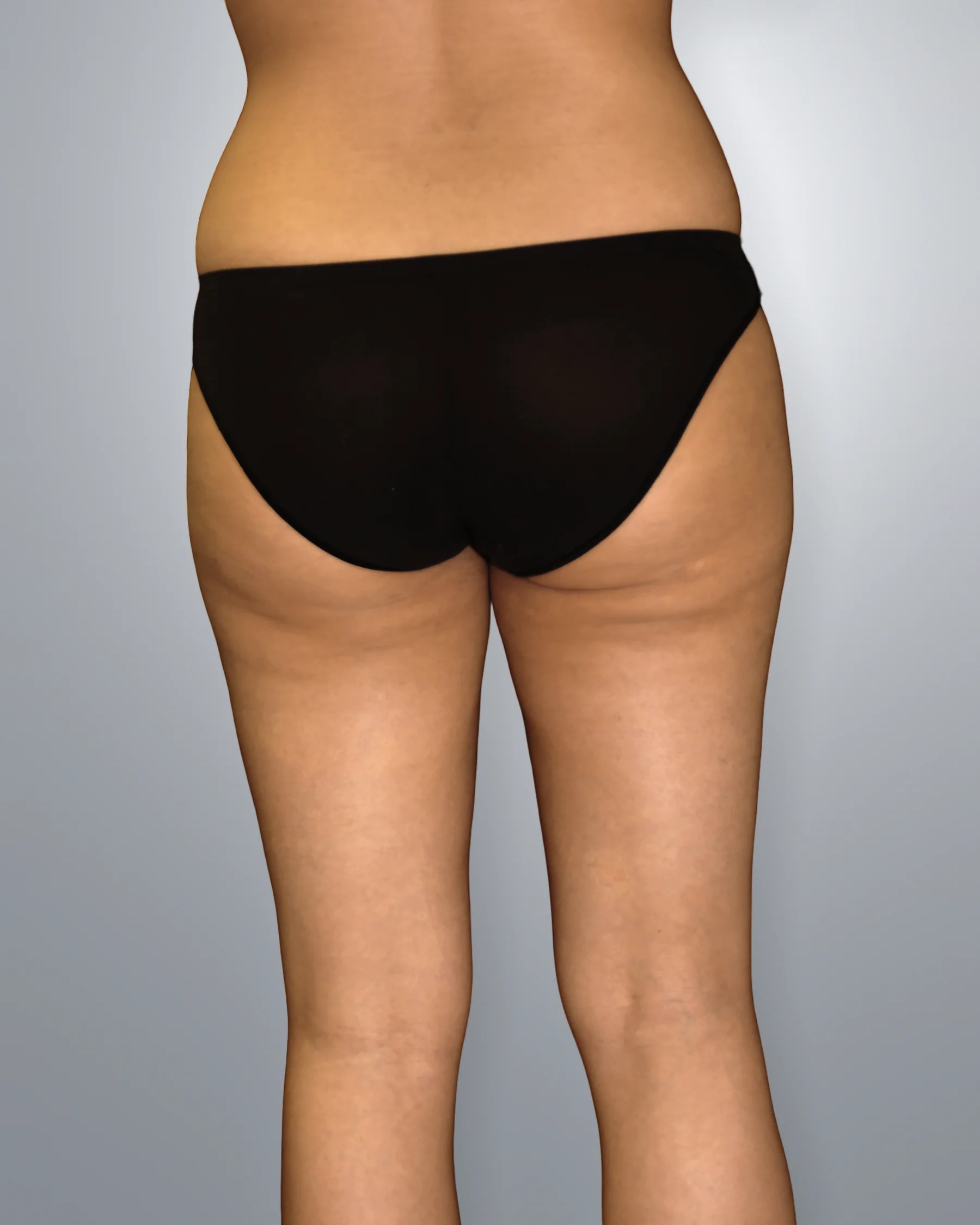 Liposuction after, Edition Plastic Surgery patient