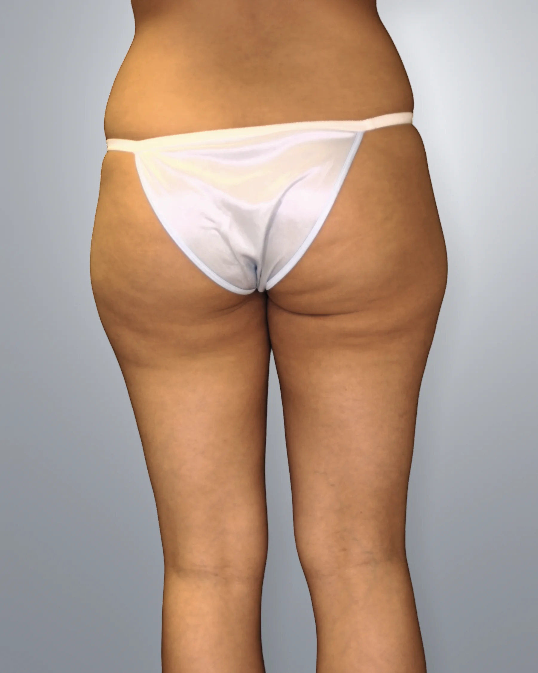 Liposuction before, Edition Plastic Surgery patient