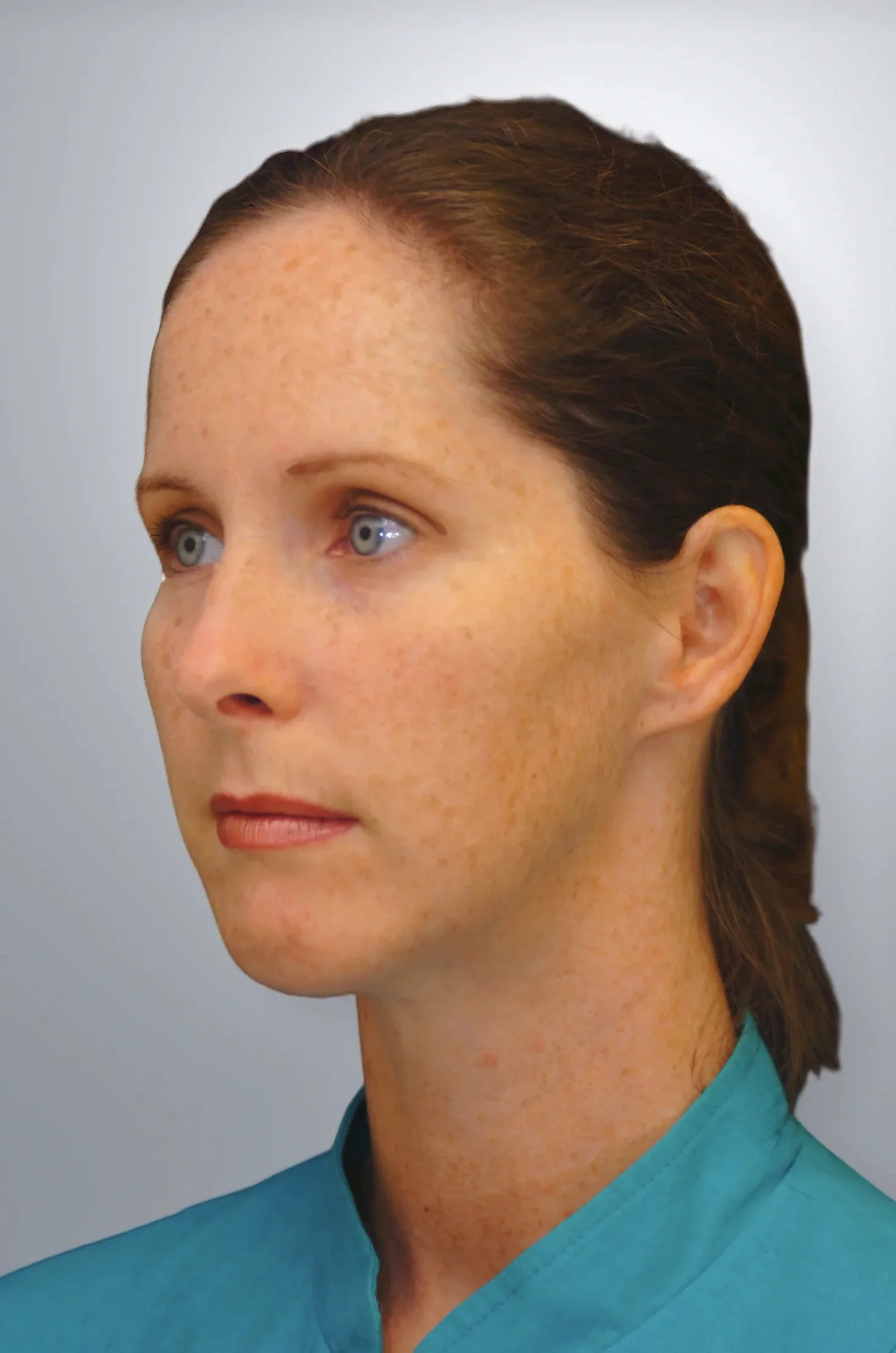 Chin Augmentation after, Edition Plastic Surgery patient