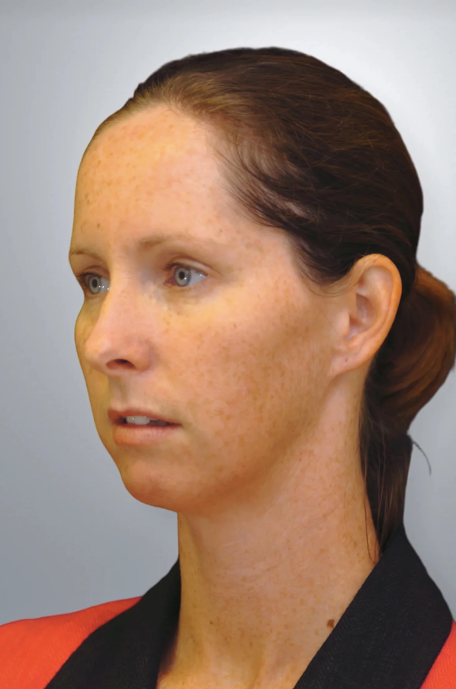 Chin Augmentation before, Edition Plastic Surgery patient