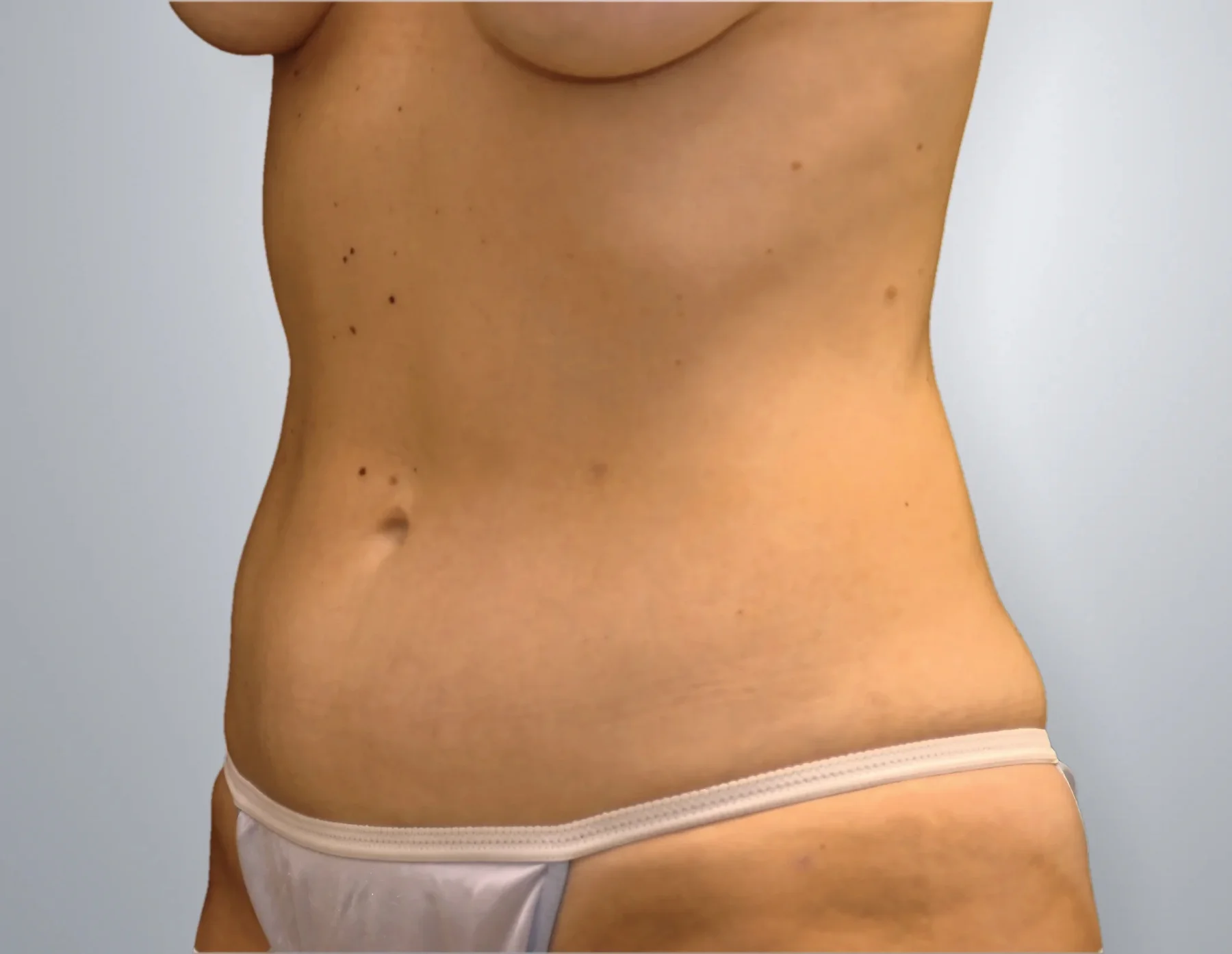 Liposuction after, Edition Plastic Surgery patient