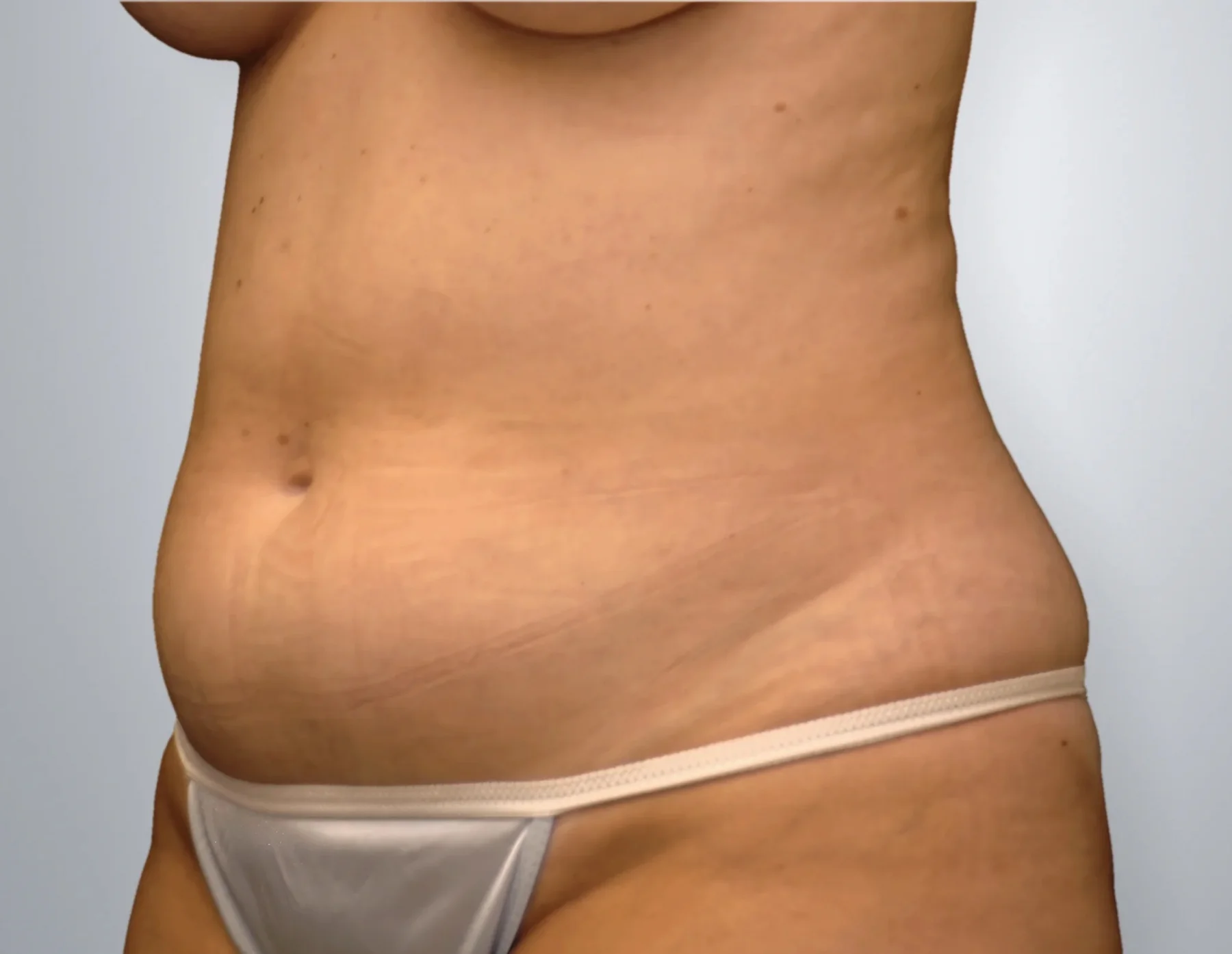 Liposuction before, Edition Plastic Surgery patient