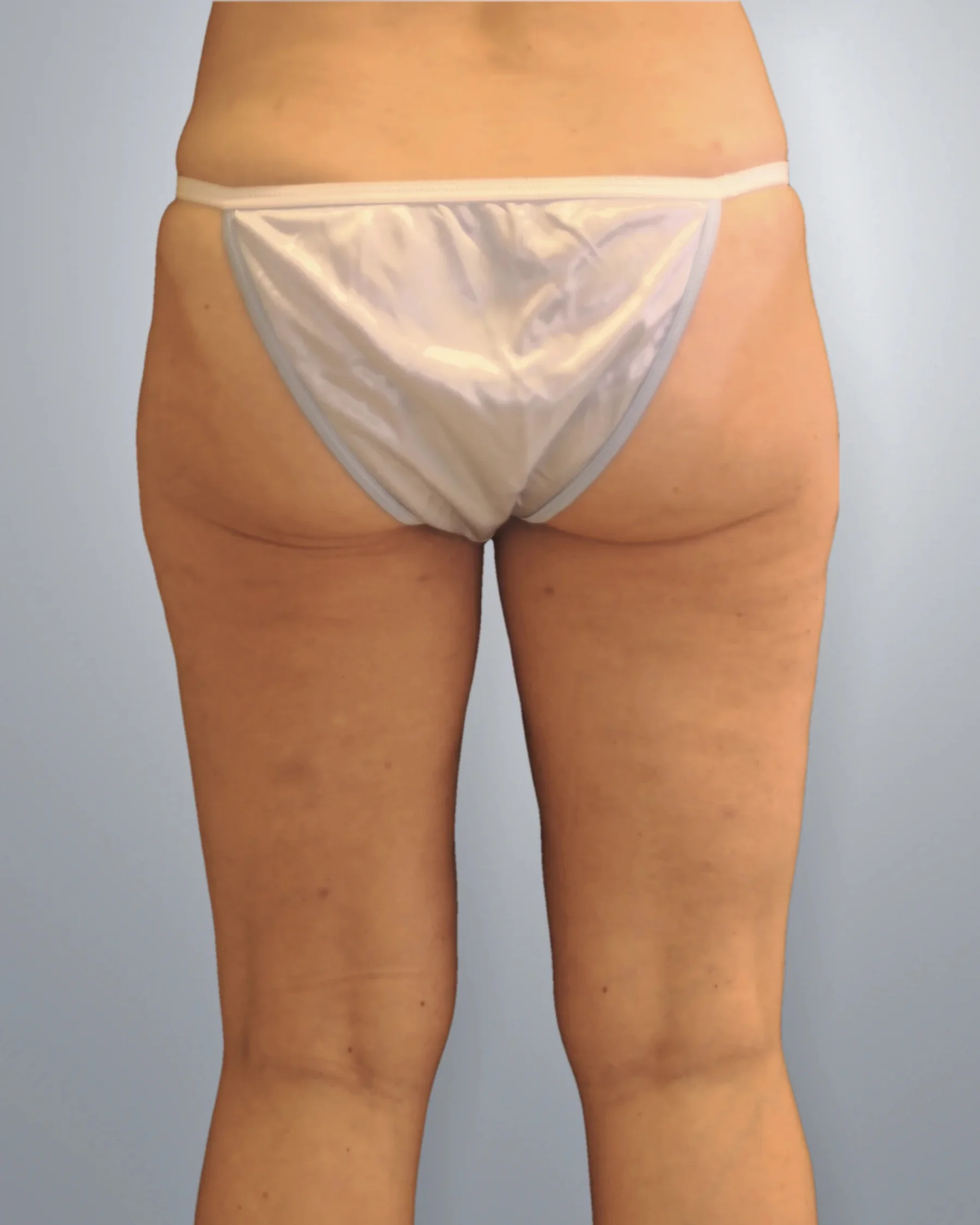 Liposuction after, Edition Plastic Surgery patient