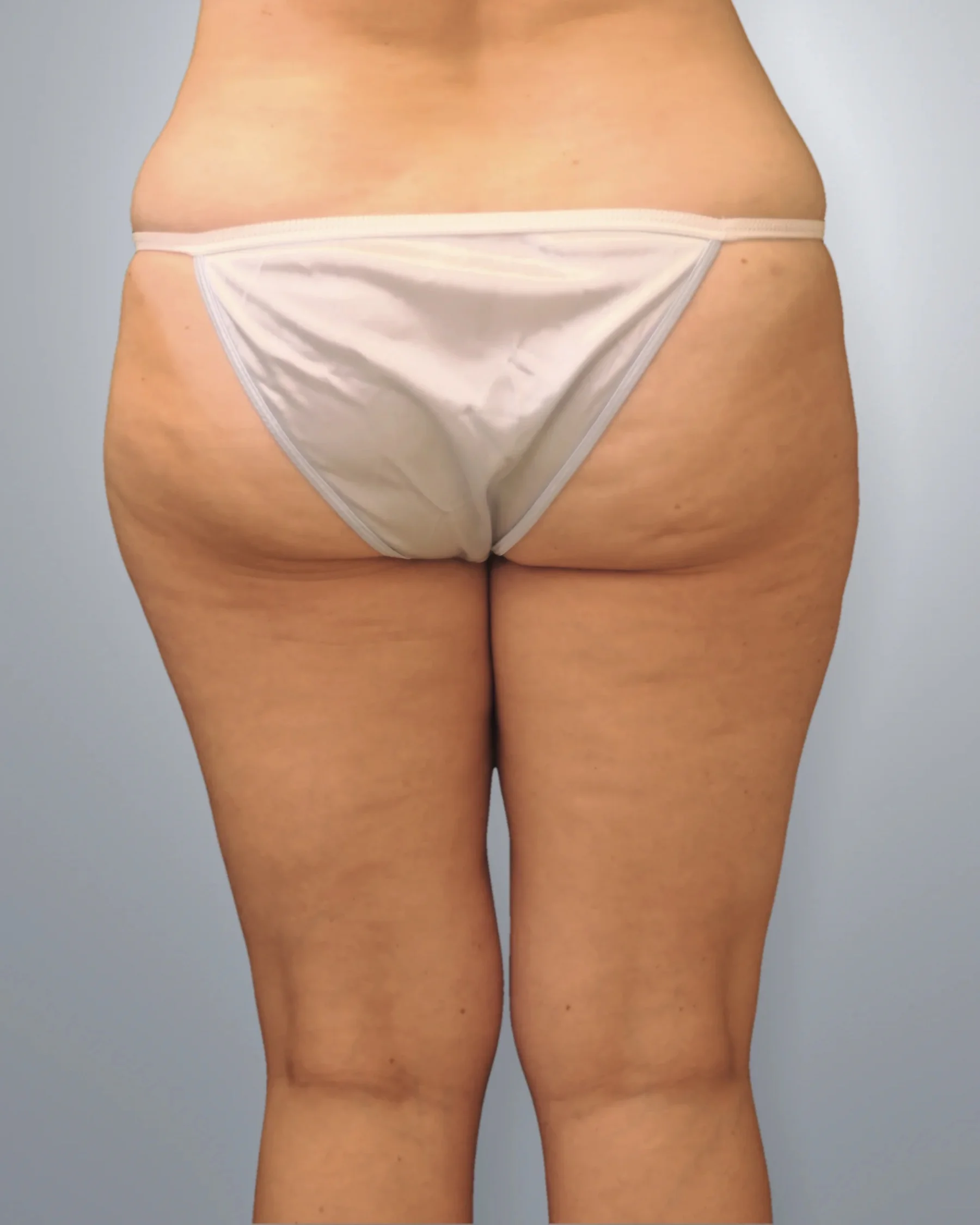 Liposuction before, Edition Plastic Surgery patient