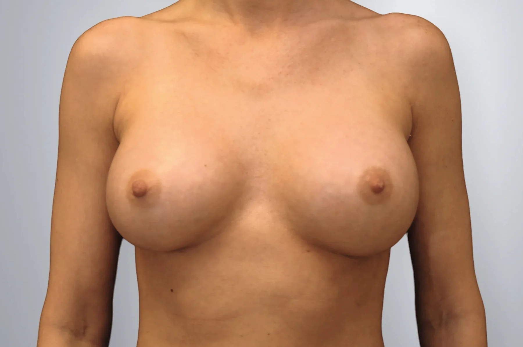 Breast Augmentation after, Edition Plastic Surgery patient