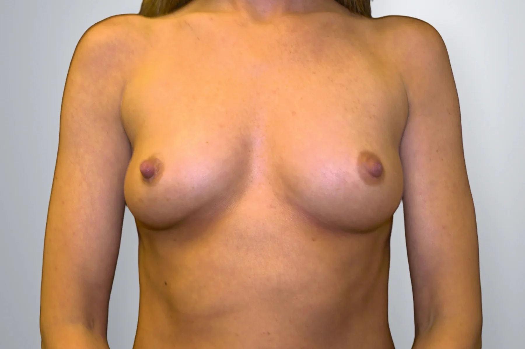 Breast Augmentation before, Edition Plastic Surgery patient