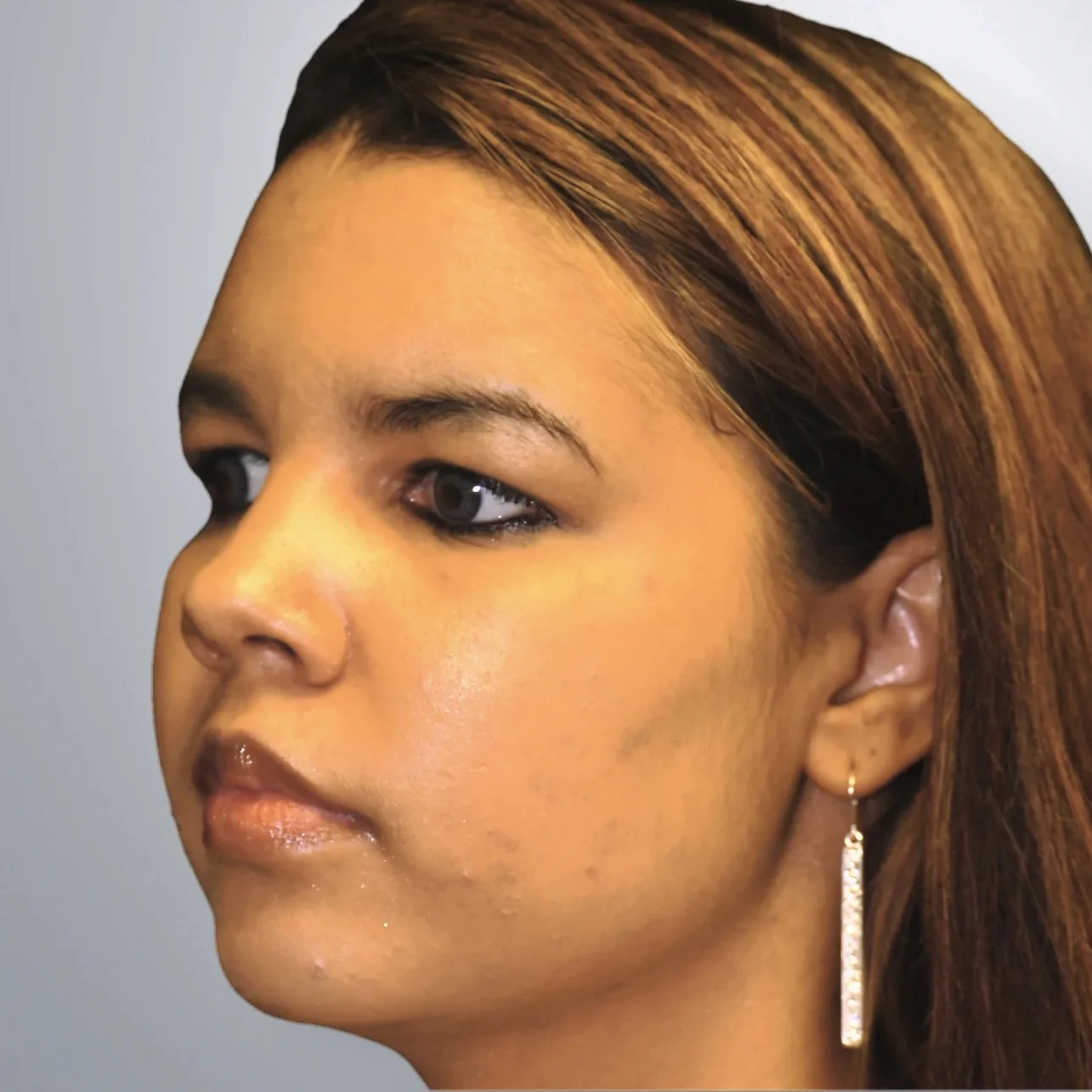 Liposuction after, Edition Plastic Surgery patient