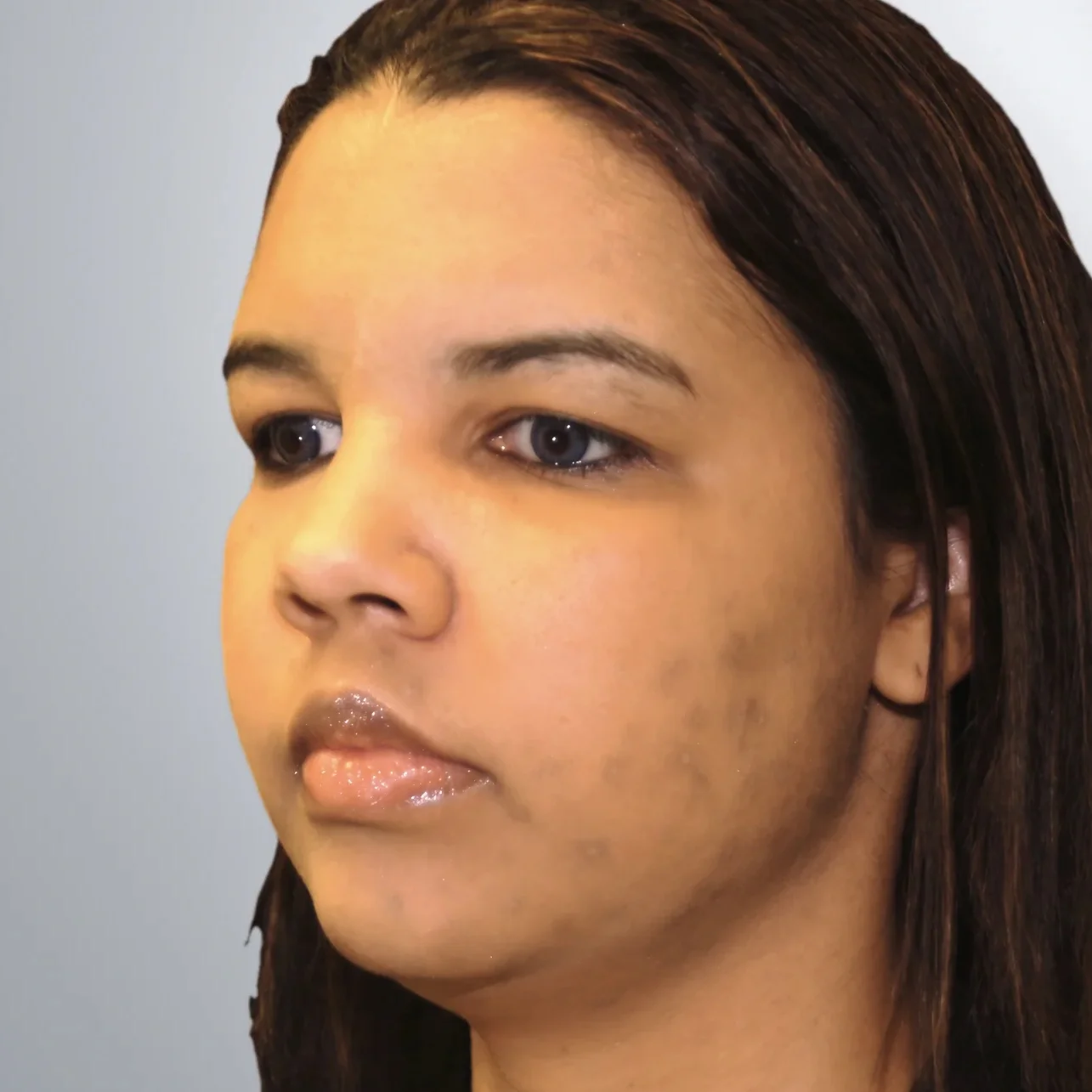 Liposuction before, Edition Plastic Surgery patient