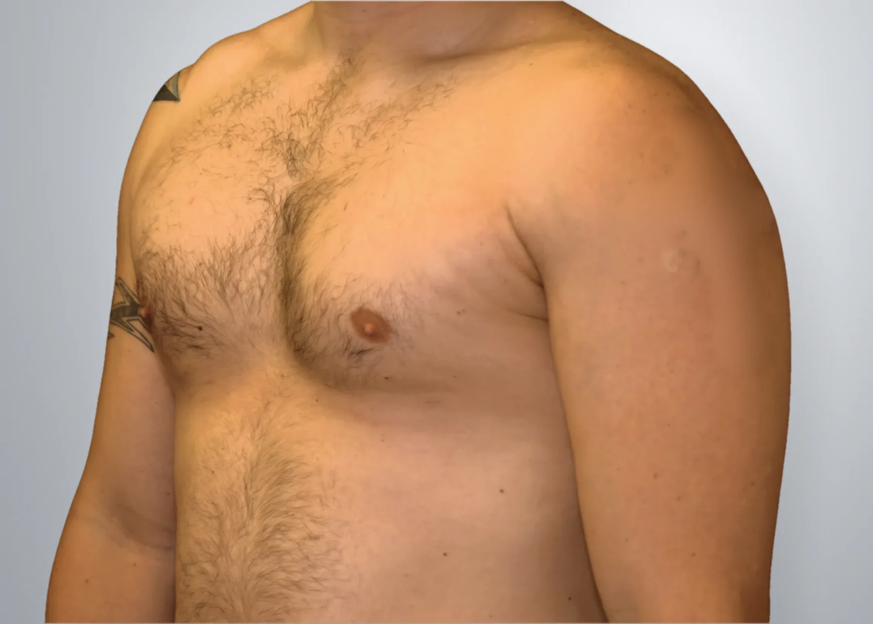 Gynecomastia + Liposuction after, Edition Plastic Surgery patient