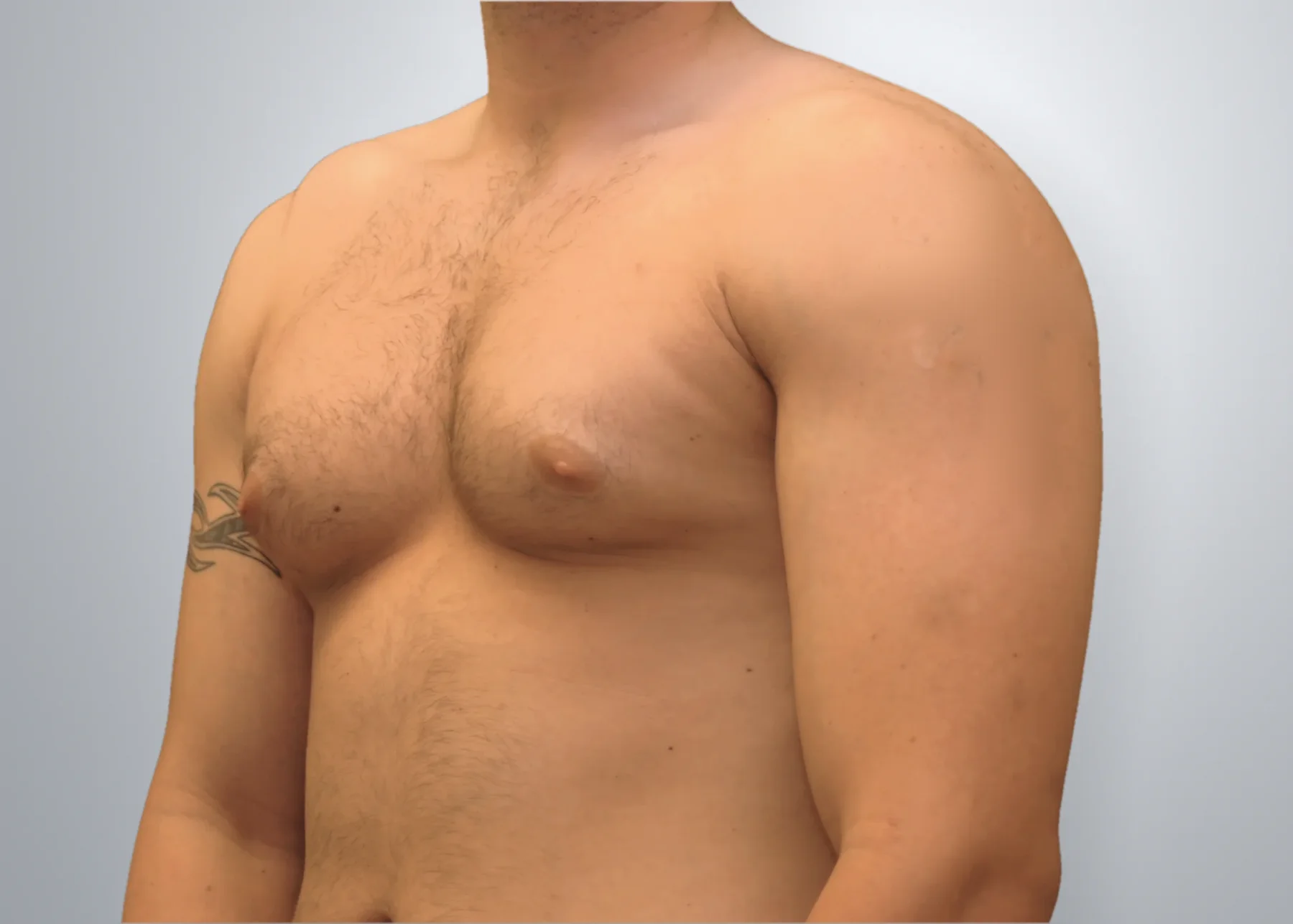 Gynecomastia + Liposuction before, Edition Plastic Surgery patient