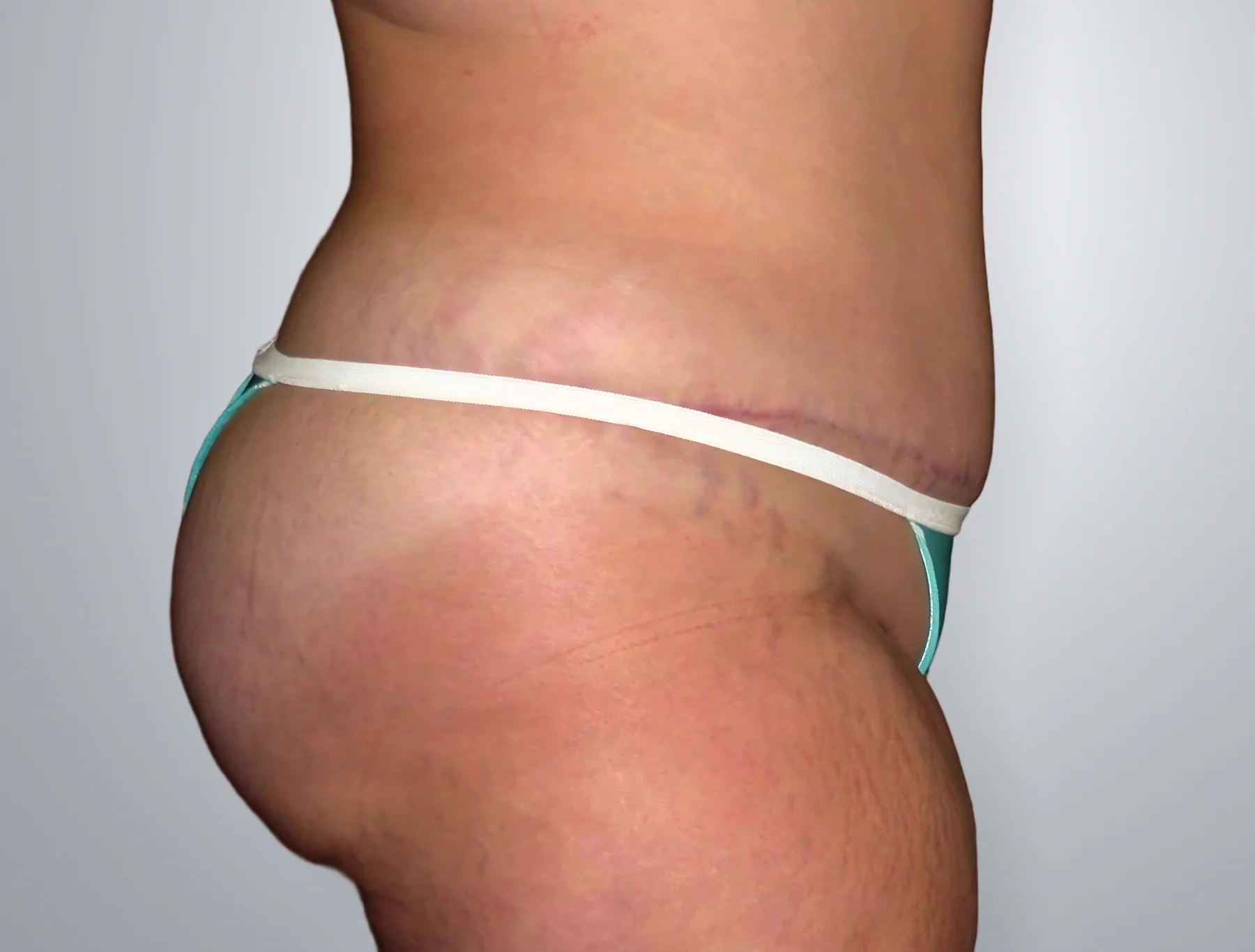 Tummy Tuck + Liposuction after, Edition Plastic Surgery patient