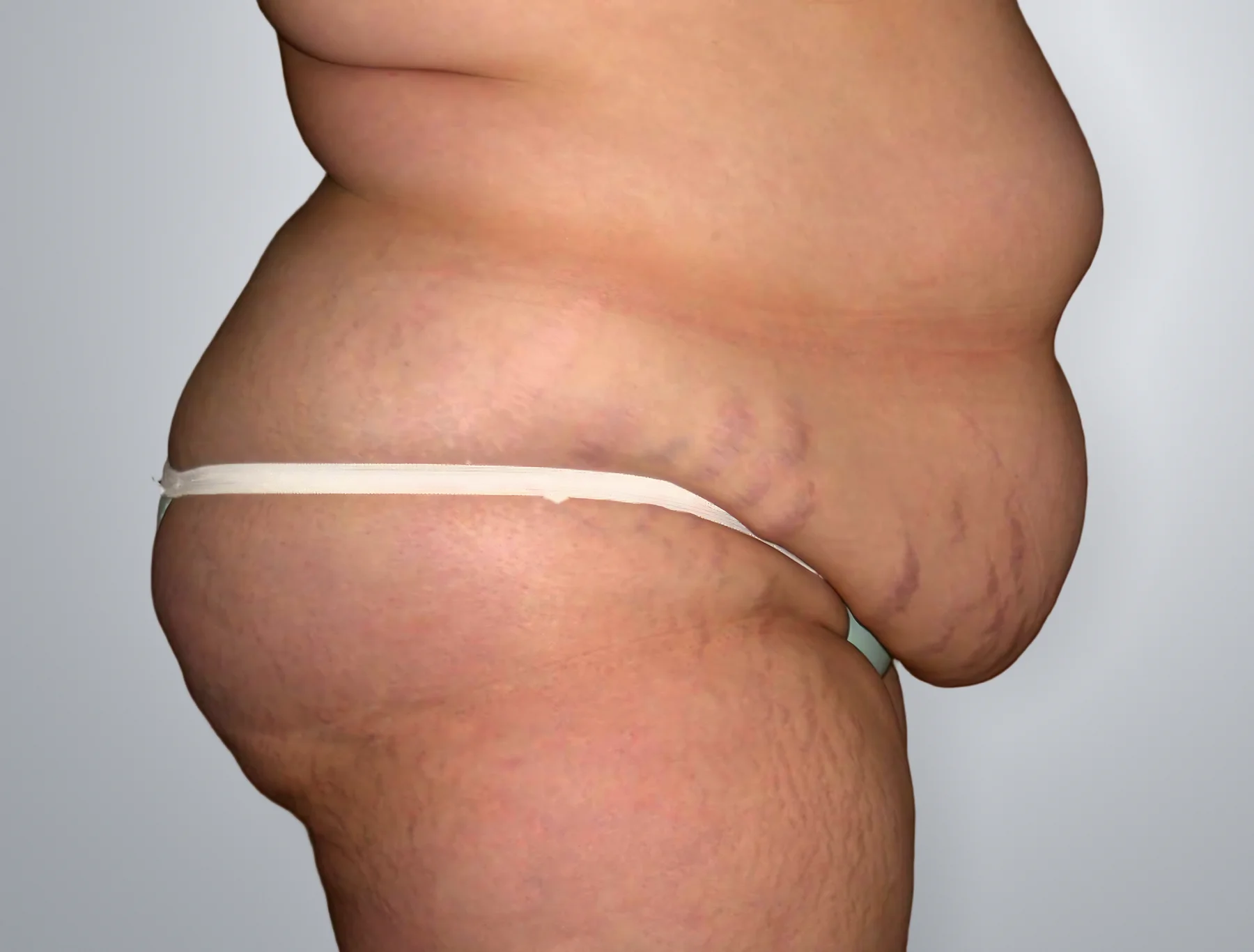 Tummy Tuck + Liposuction before, Edition Plastic Surgery patient