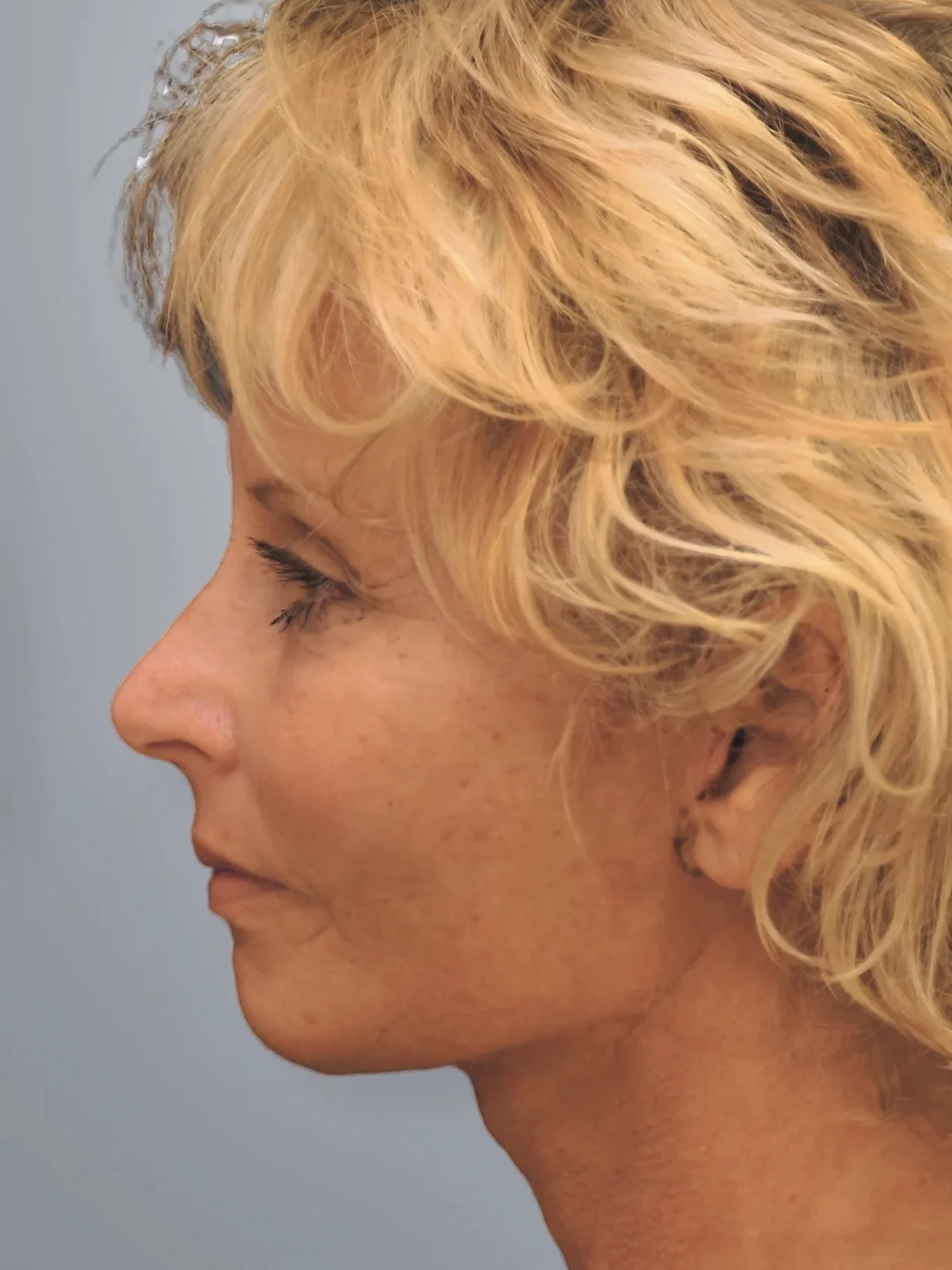 Brow Lift + Facelift + Midface Lift after, Edition Plastic Surgery patient