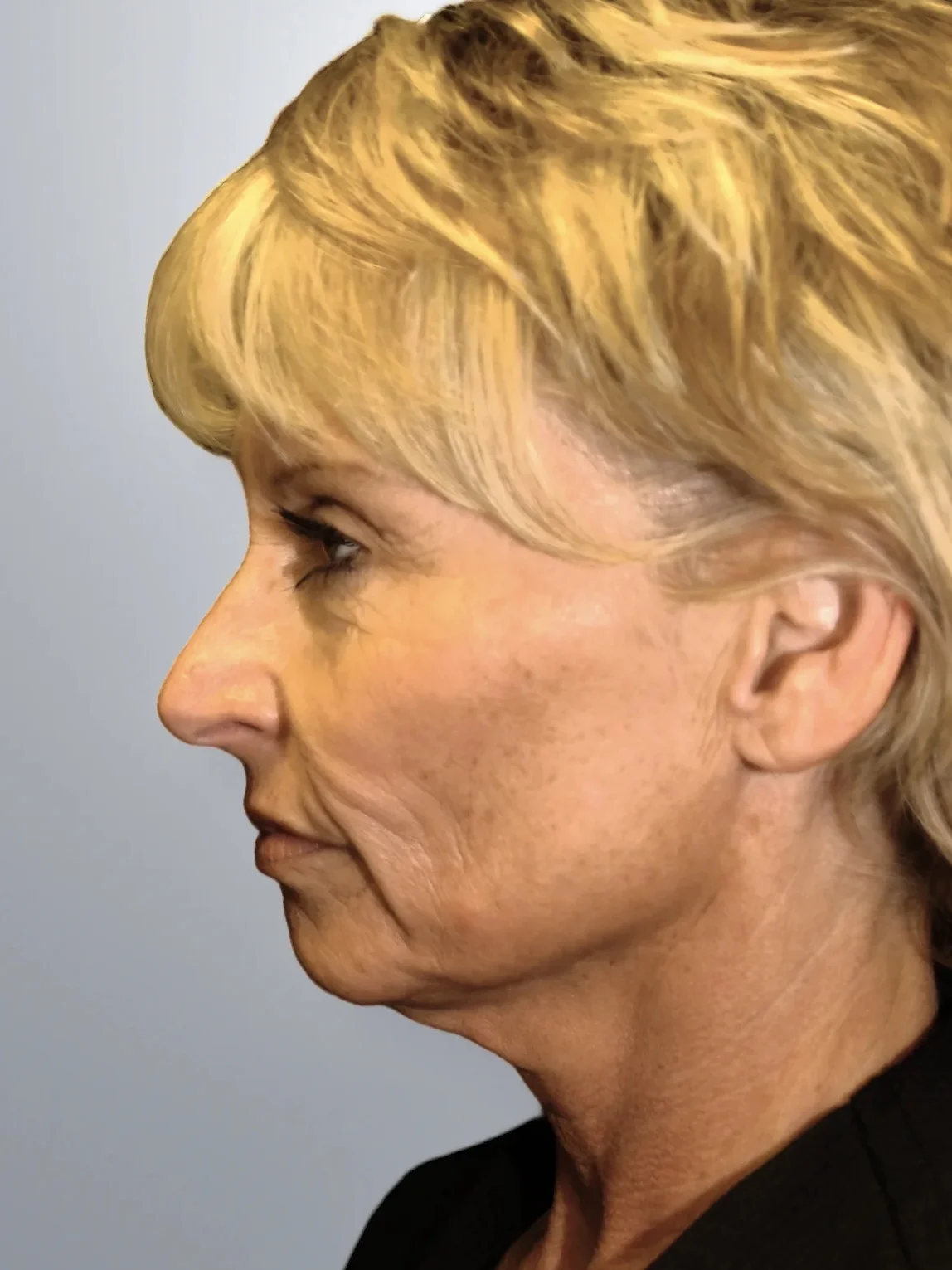 Brow Lift + Facelift + Midface Lift before, Edition Plastic Surgery patient