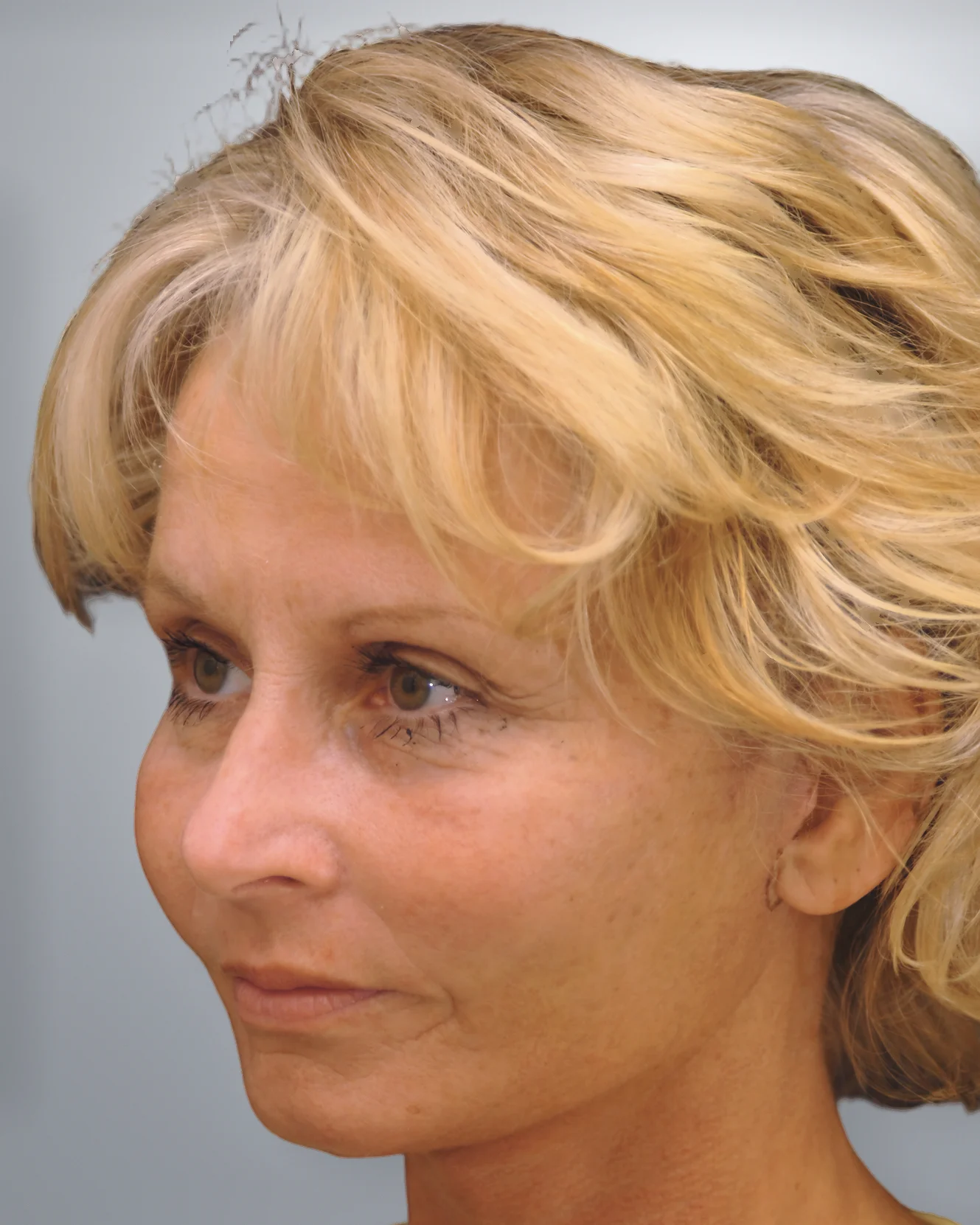 Brow Lift + Midface Lift + Facelift after, Edition Plastic Surgery patient