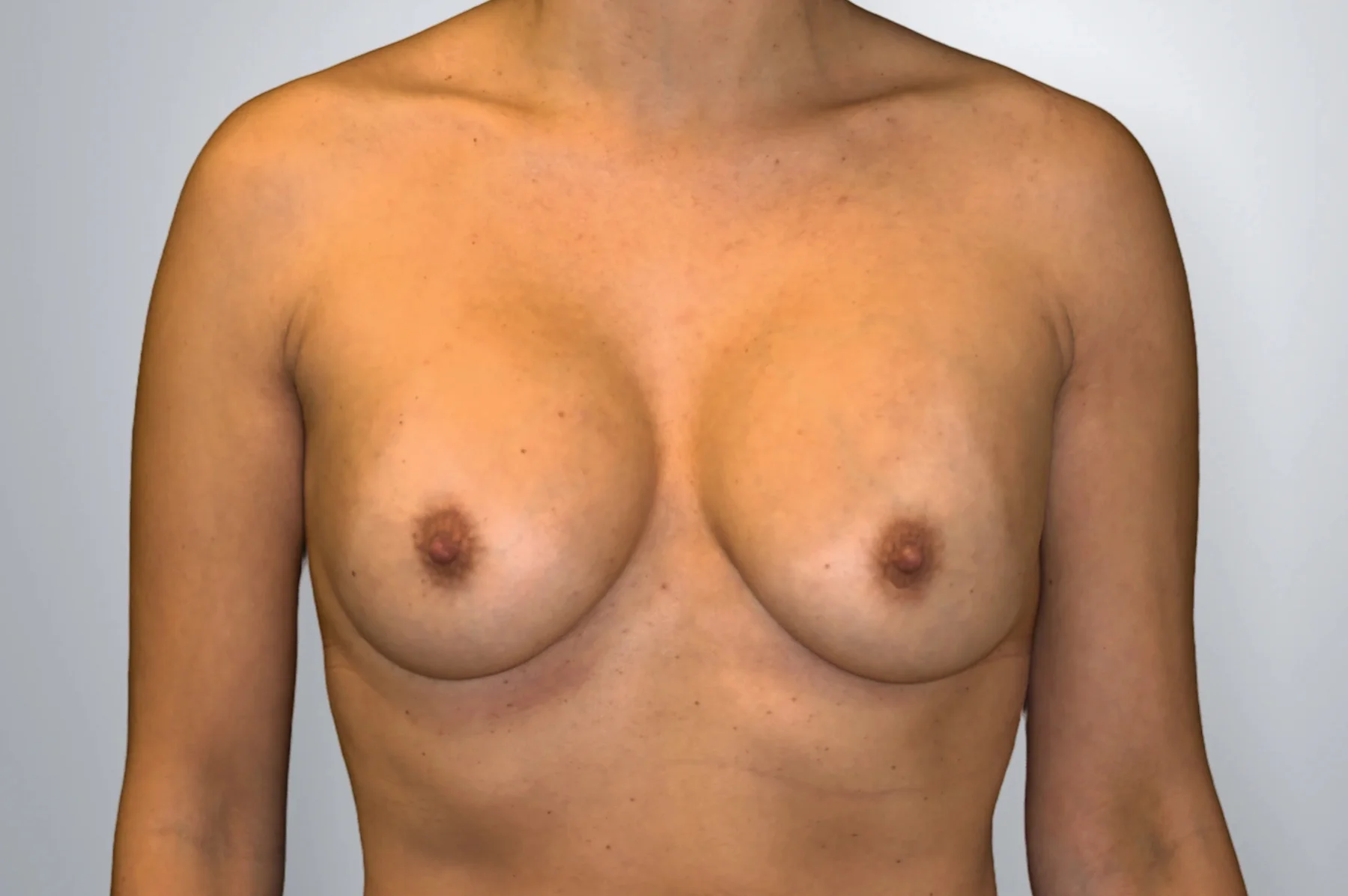 Breast Implant Revision before, Edition Plastic Surgery patient