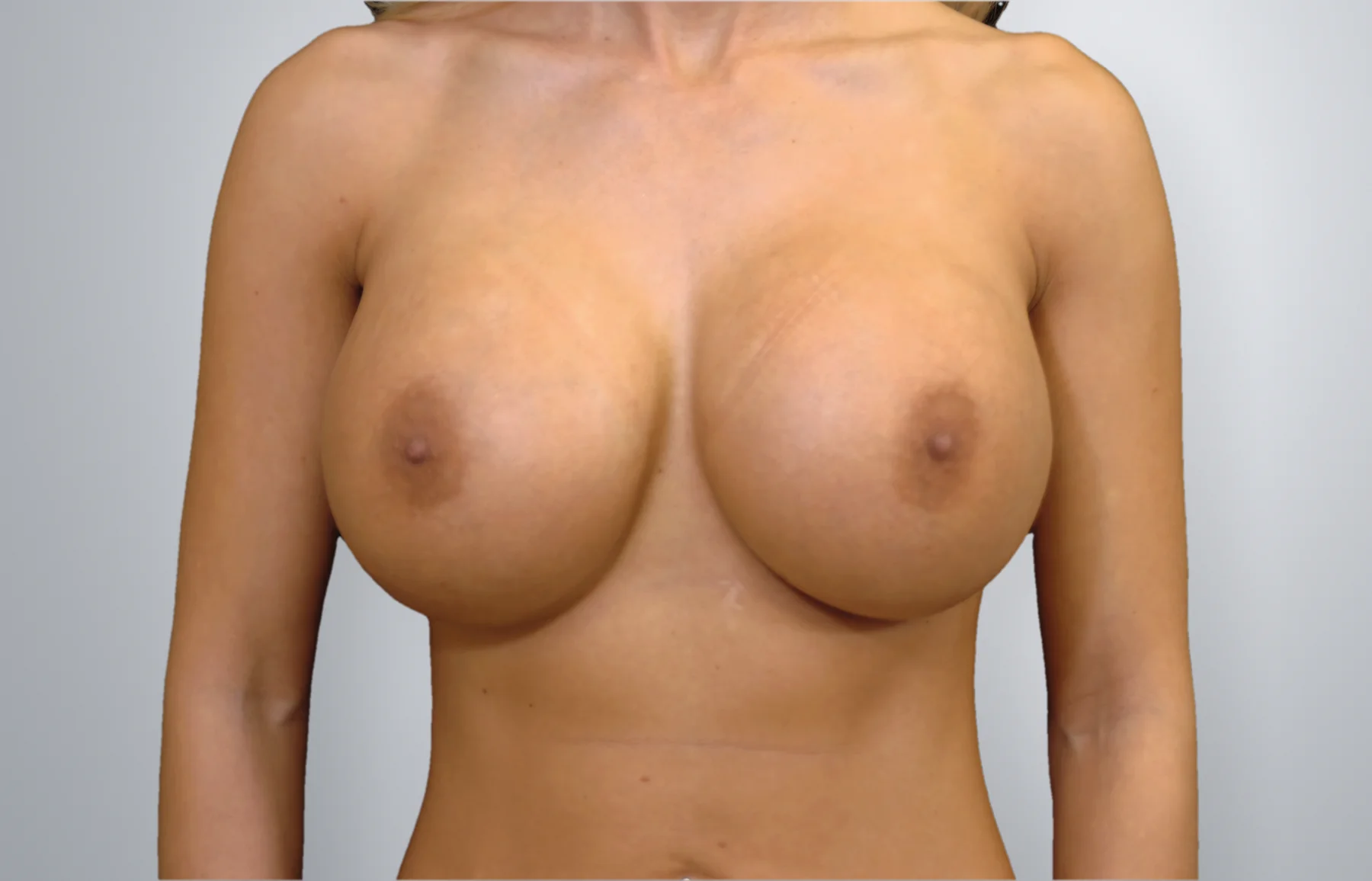 Breast Implant Revision after, Edition Plastic Surgery patient