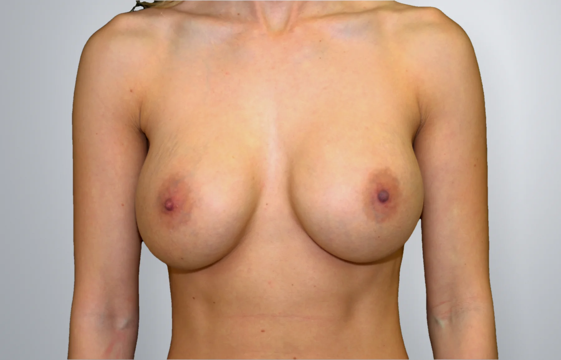 Breast Implant Revision before, Edition Plastic Surgery patient