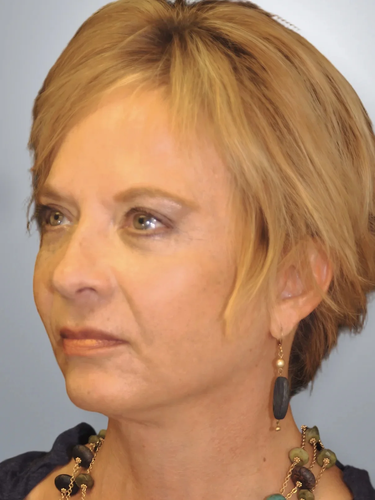 Facelift + Brow Lift + Midface Lift after, Edition Plastic Surgery patient