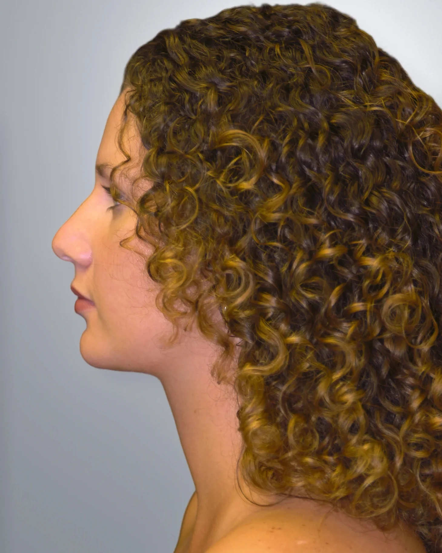 Liposuction after, Edition Plastic Surgery patient