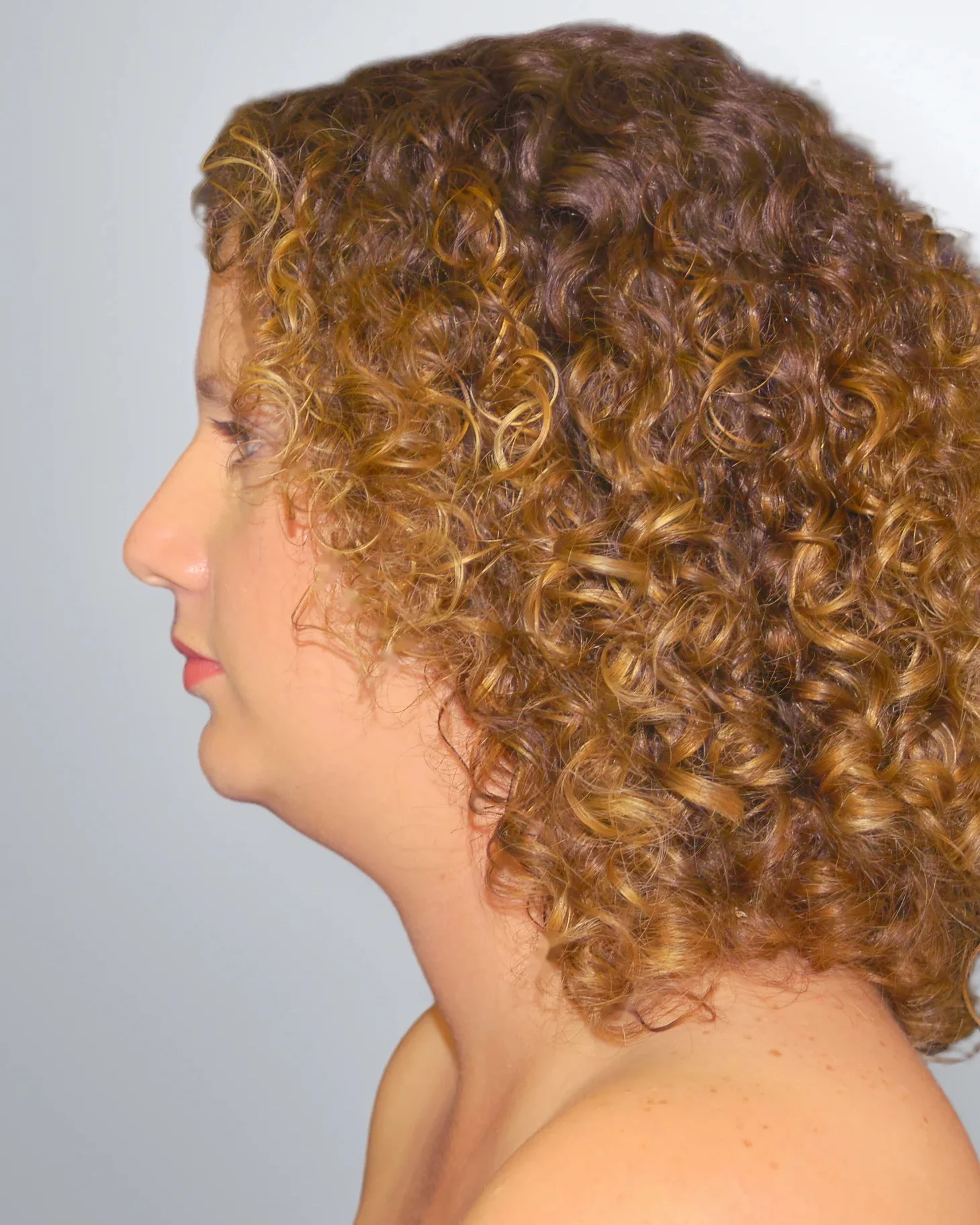Liposuction before, Edition Plastic Surgery patient