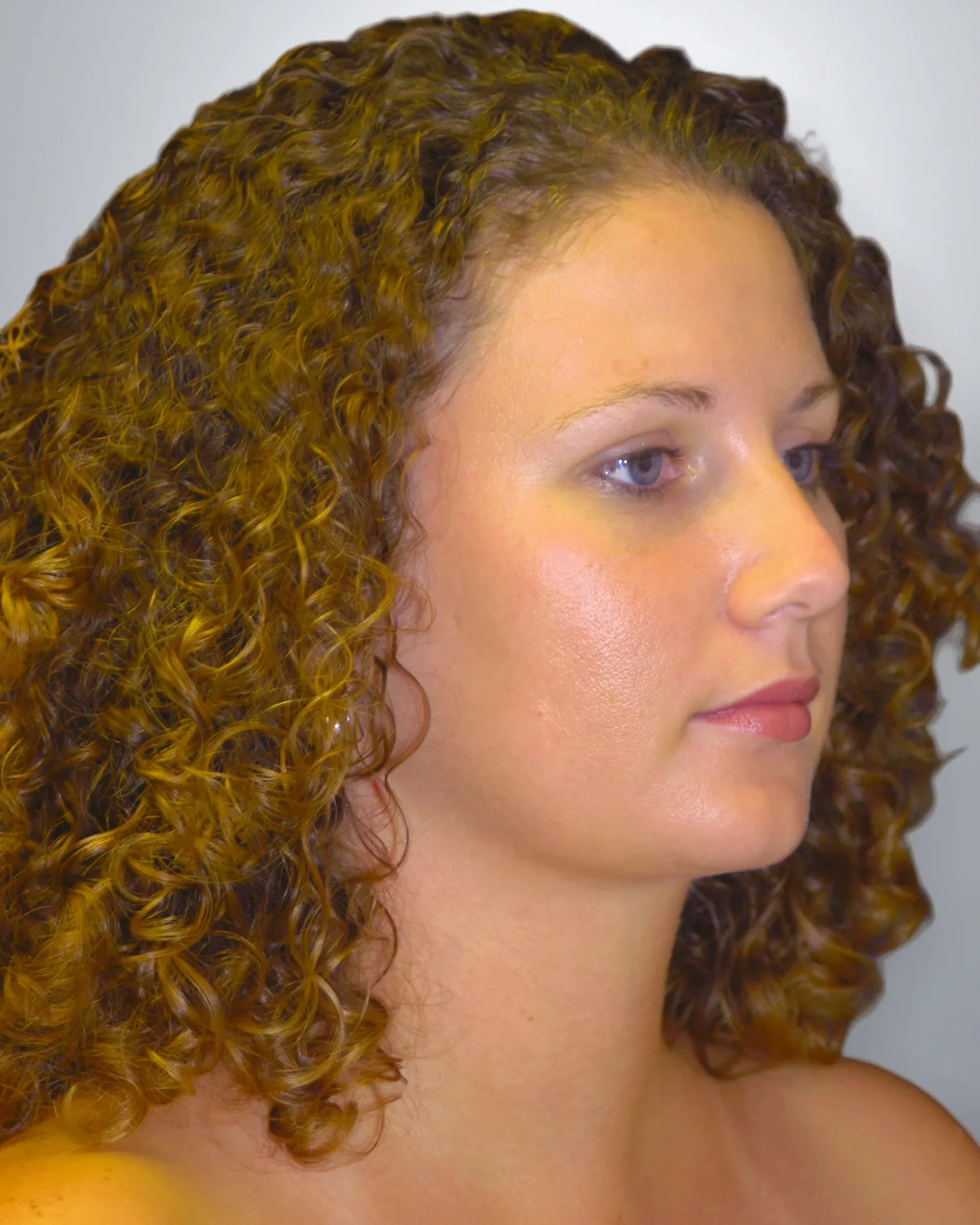 Liposuction after, Edition Plastic Surgery patient