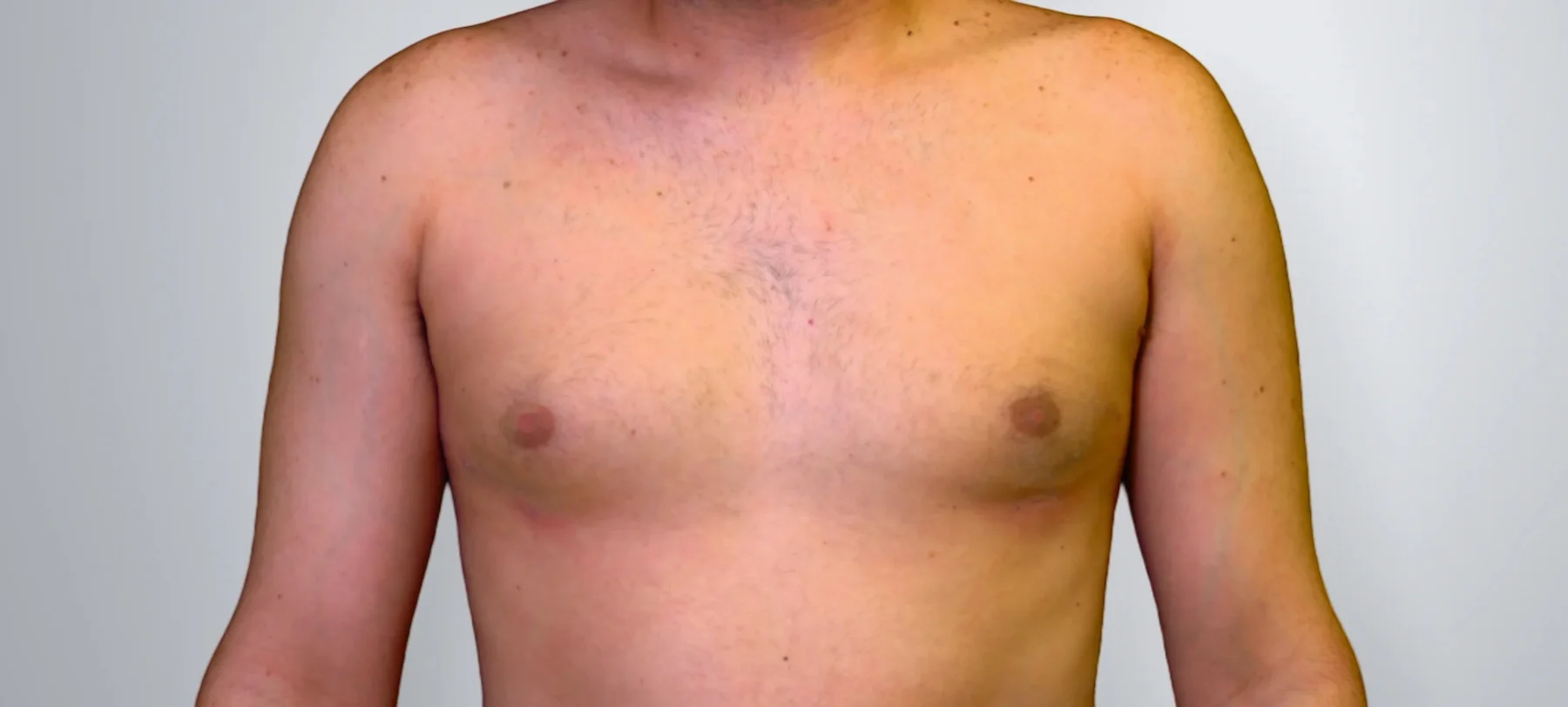Gynecomastia + Liposuction after, Edition Plastic Surgery patient