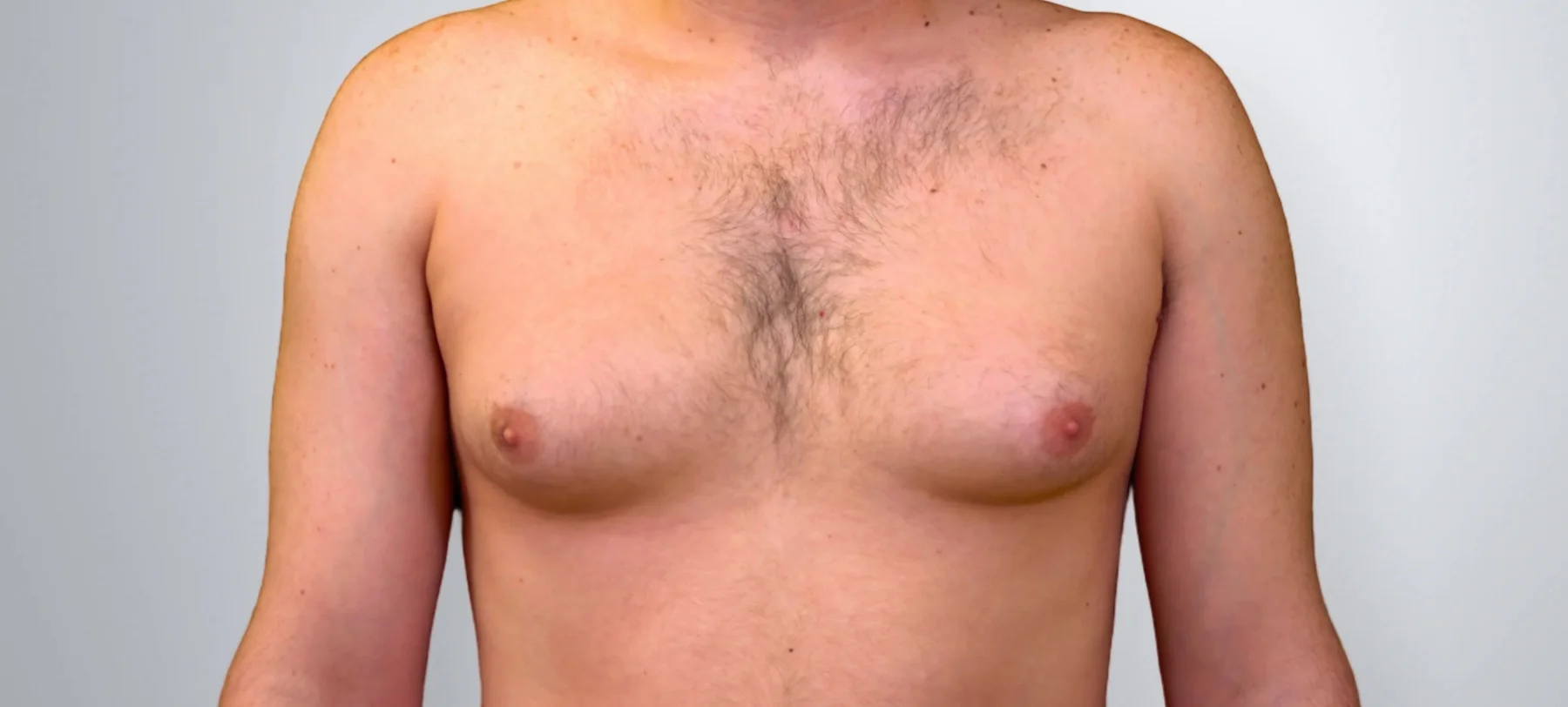 Gynecomastia + Liposuction before, Edition Plastic Surgery patient
