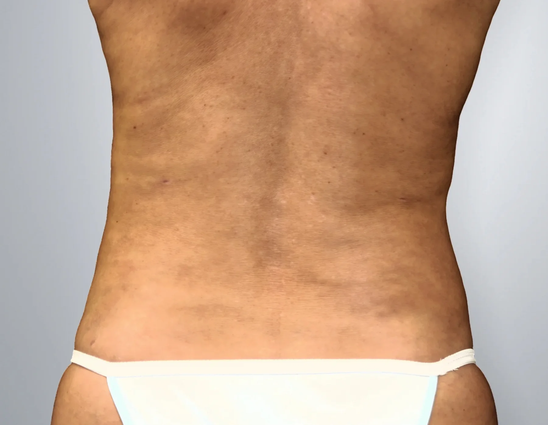 Liposuction after, Edition Plastic Surgery patient