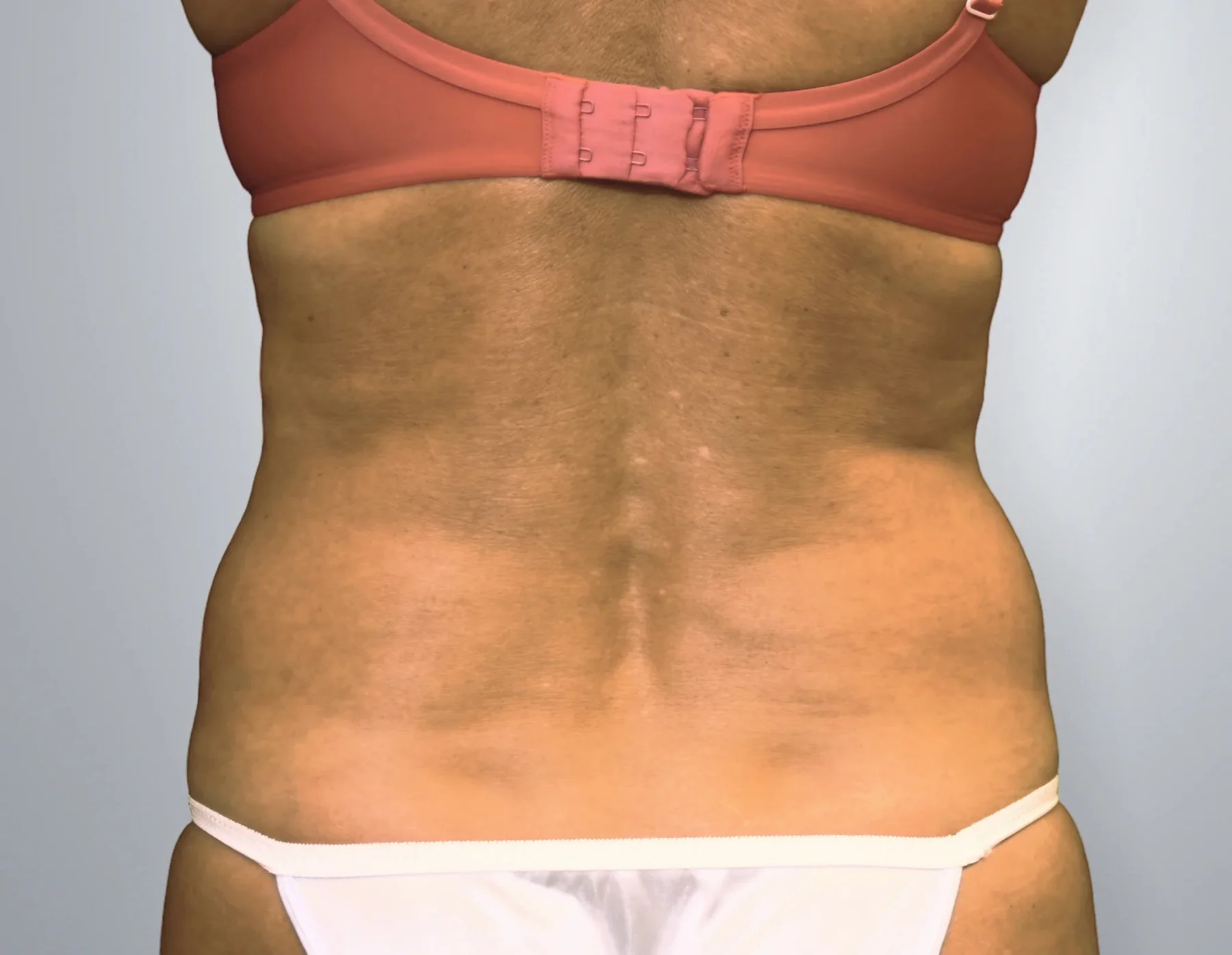 Liposuction before, Edition Plastic Surgery patient